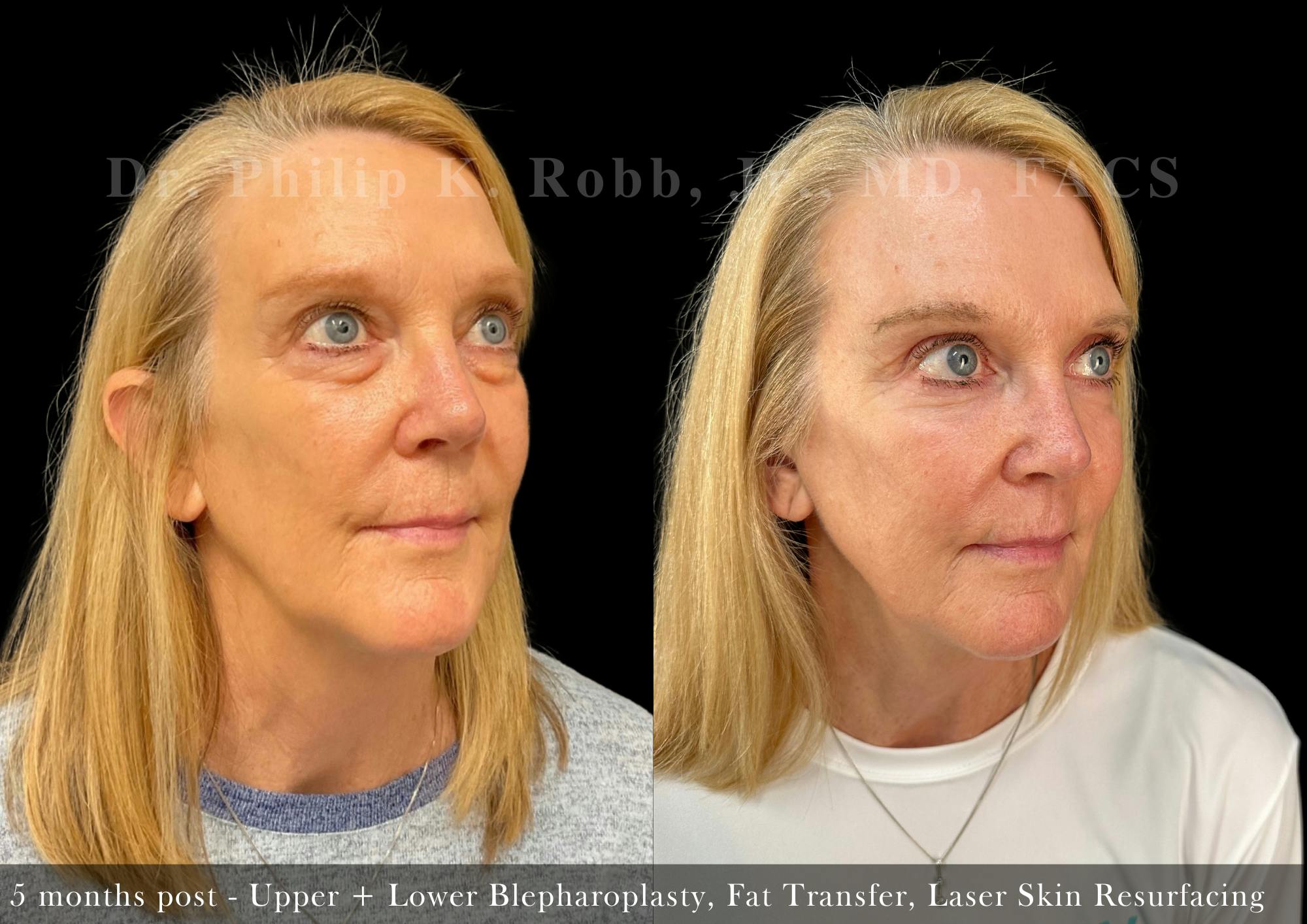 Face Before & After Gallery - Patient 206653770 - Image 3