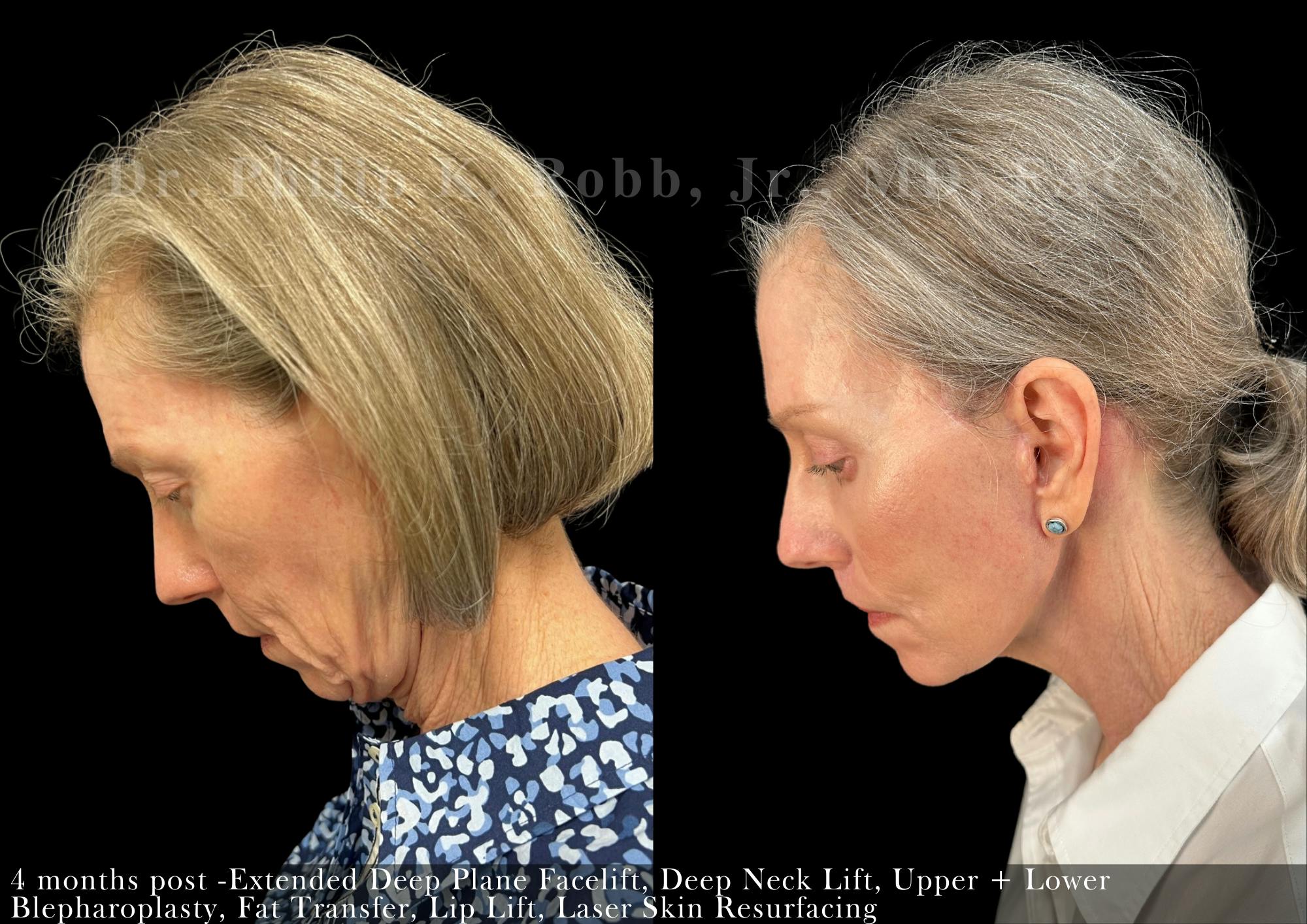 Face Before & After Gallery - Patient 206656616 - Image 6