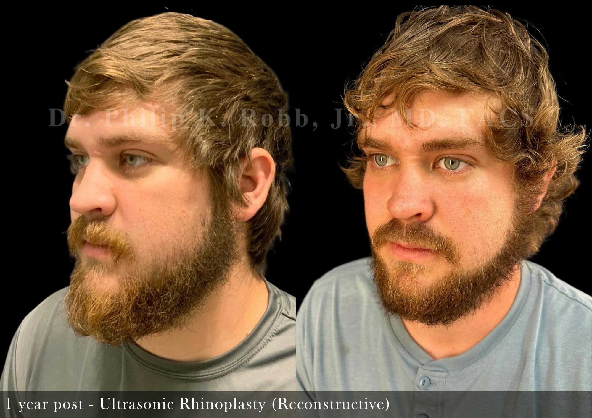 Nose Before & After Gallery - Patient 142949 - Image 3