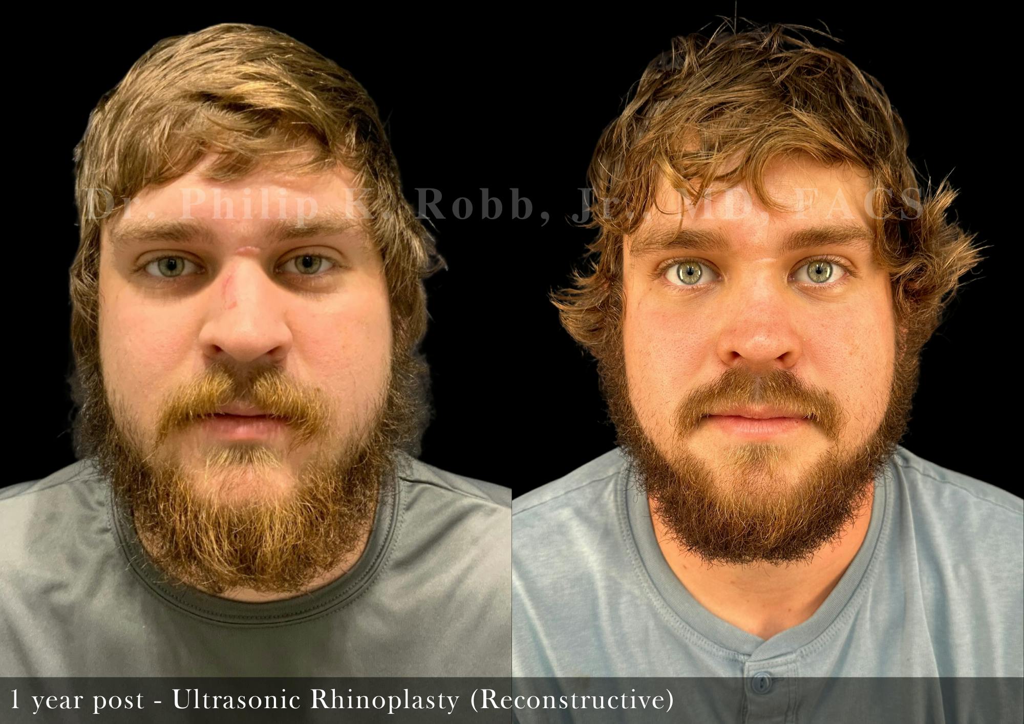 Nose Before & After Gallery - Patient 142949 - Image 4