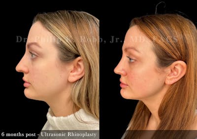Nose Before & After Gallery - Patient 321435 - Image 1
