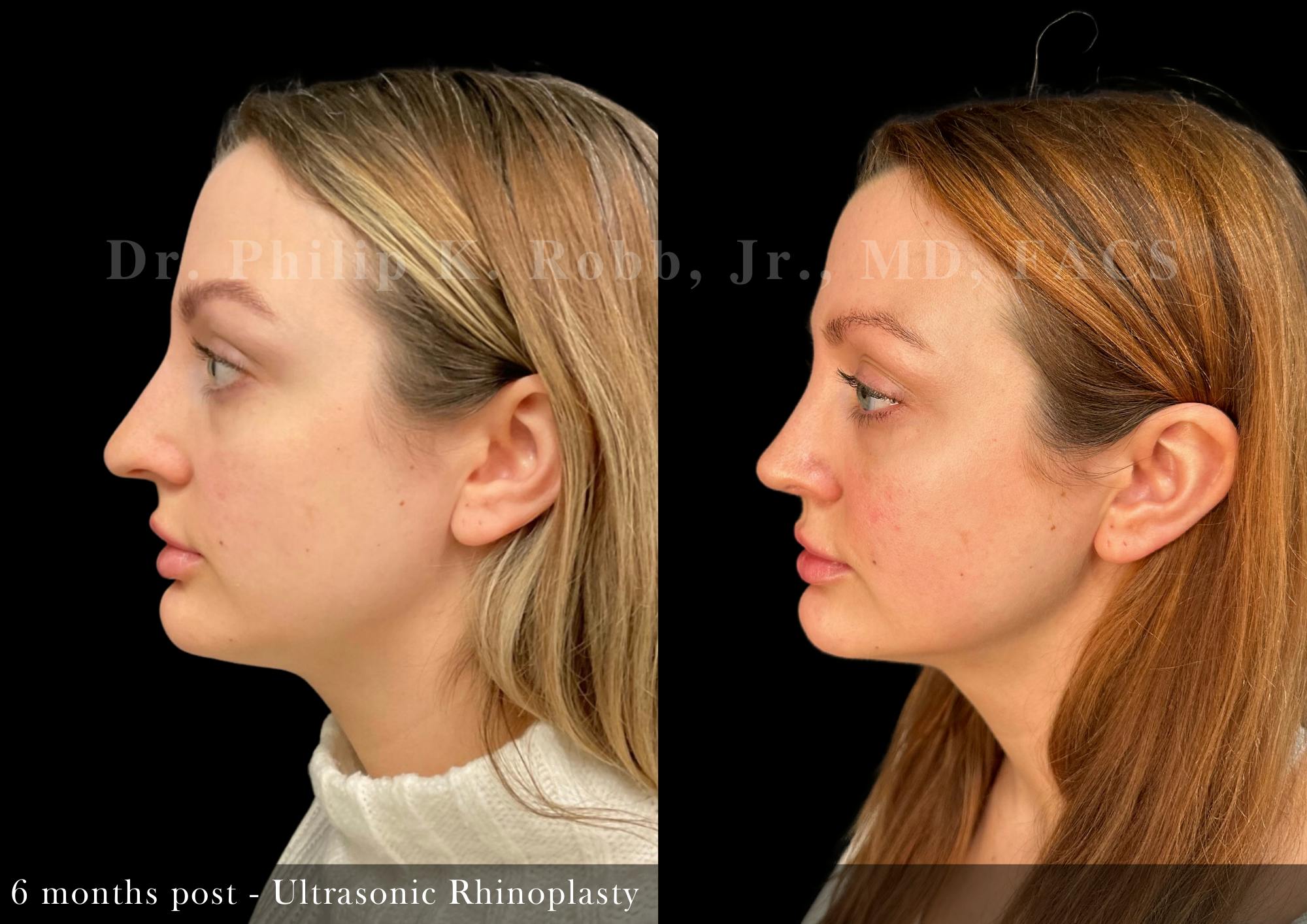 Nose Before & After Gallery - Patient 321435 - Image 1