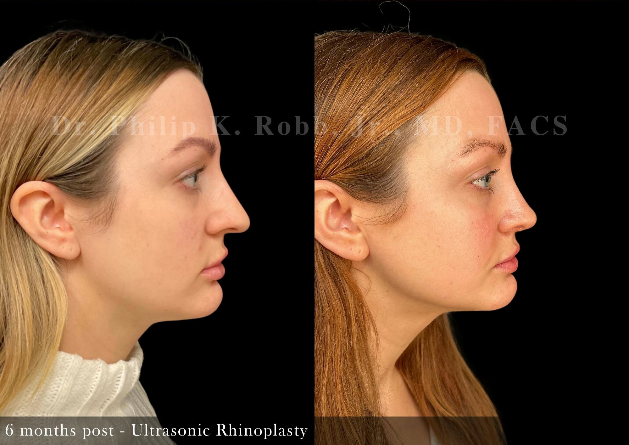Nose Before & After Gallery - Patient 321435 - Image 2