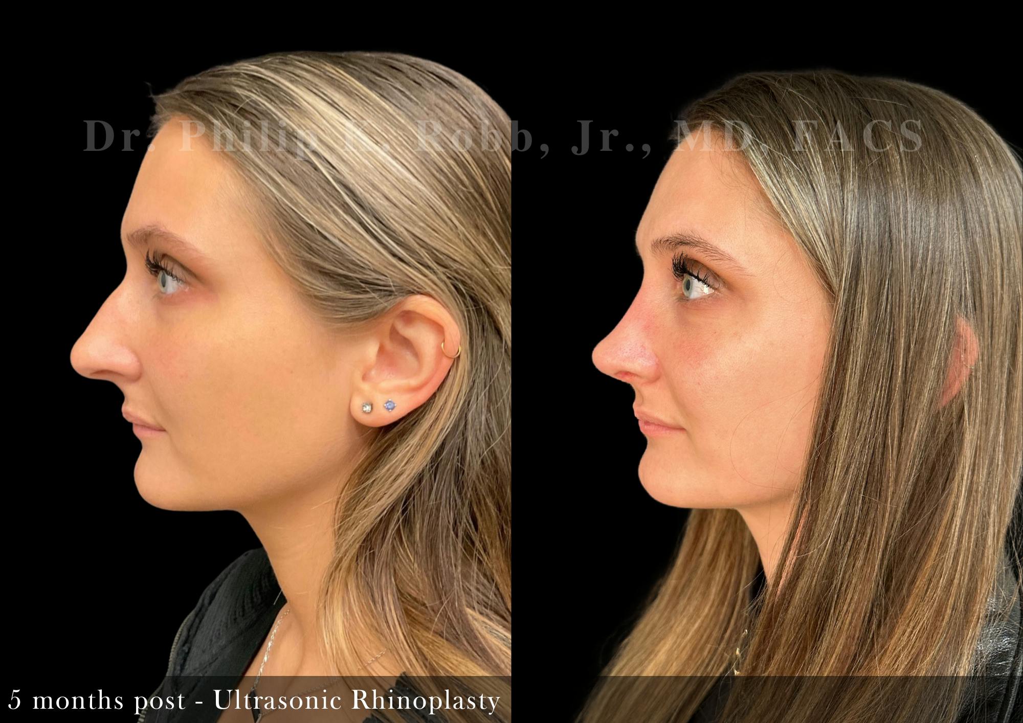 Nose Before & After Gallery - Patient 429296 - Image 1