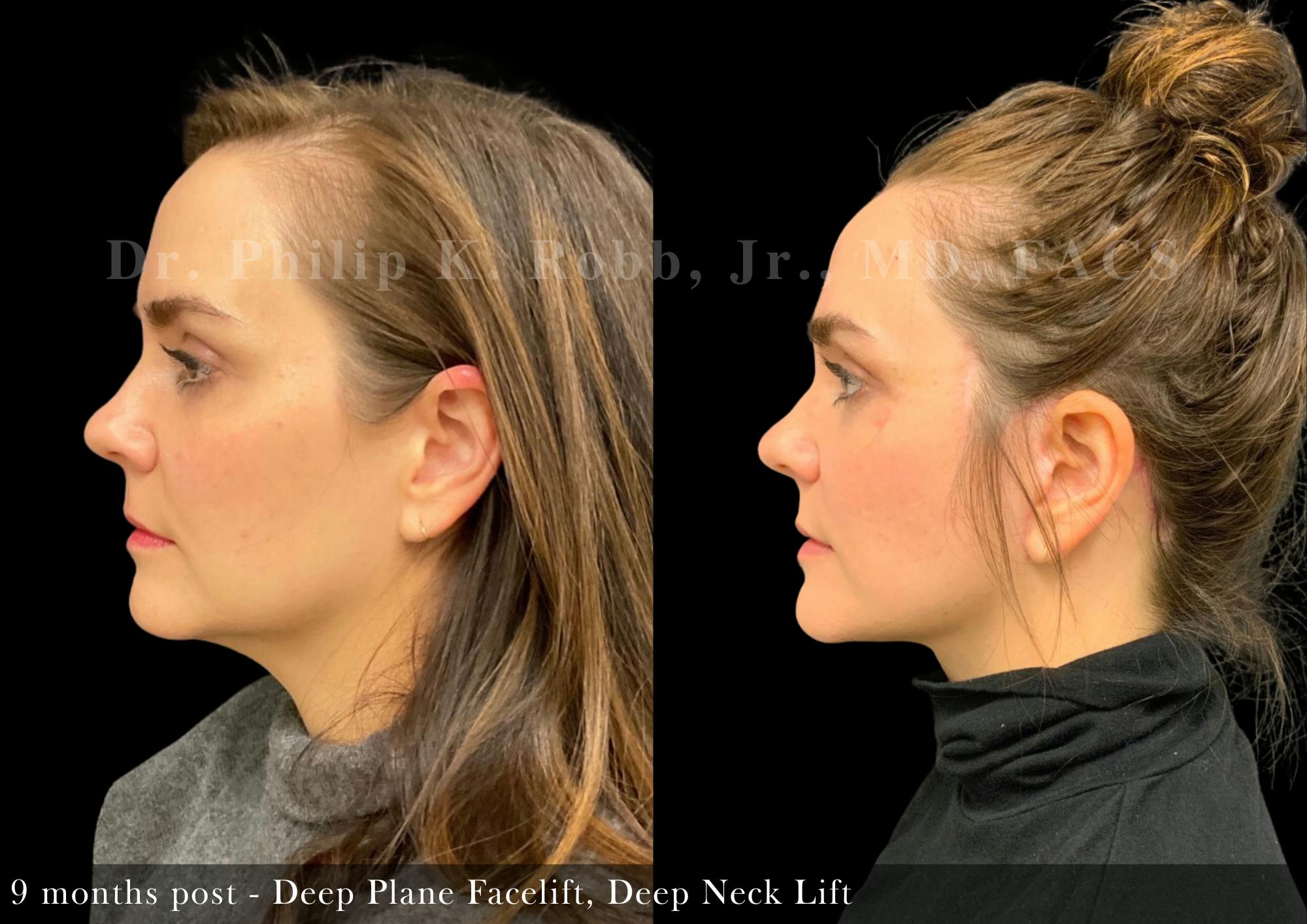 Face Before & After Gallery - Patient 418624 - Image 5