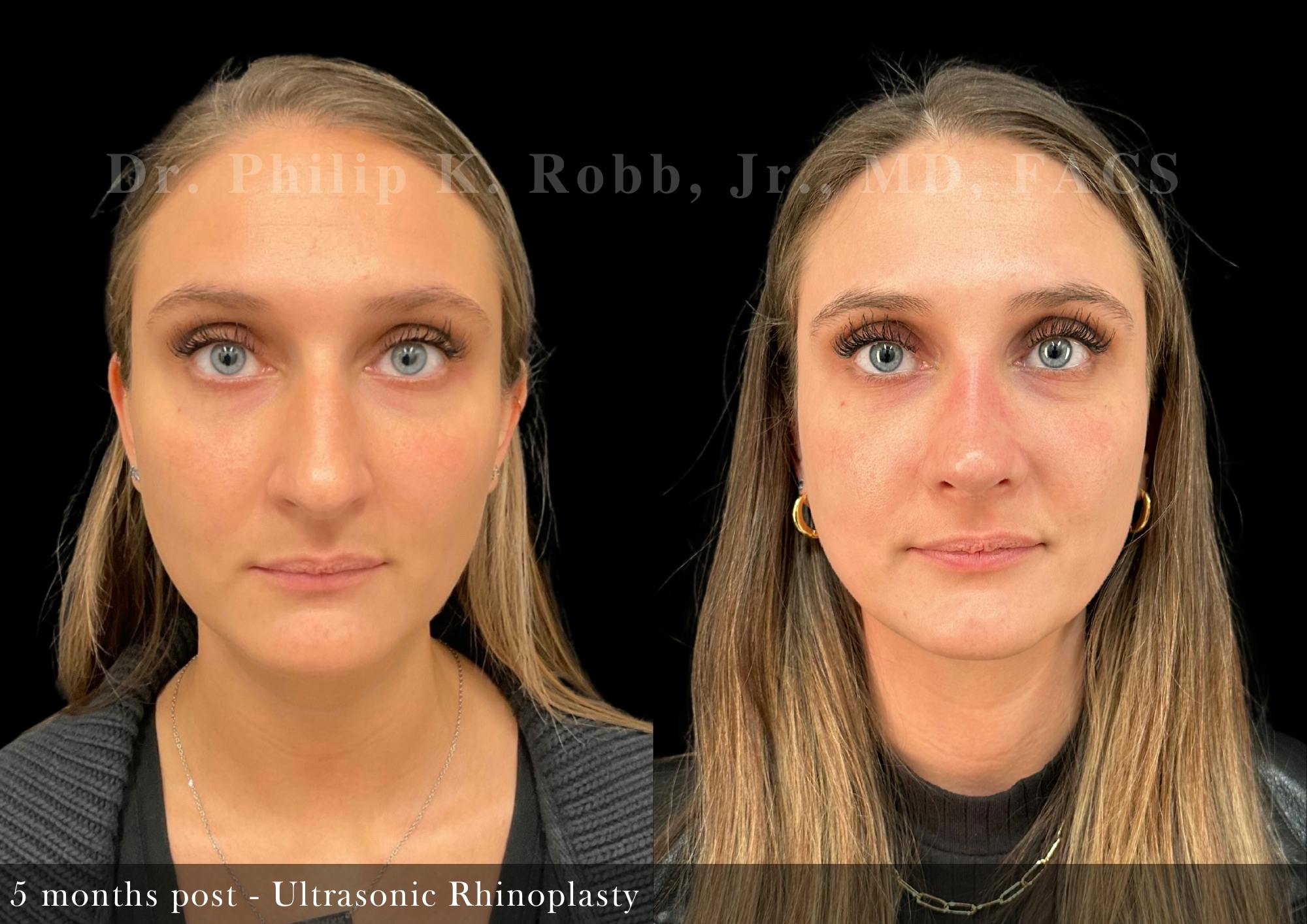 Nose Before & After Gallery - Patient 429296 - Image 3