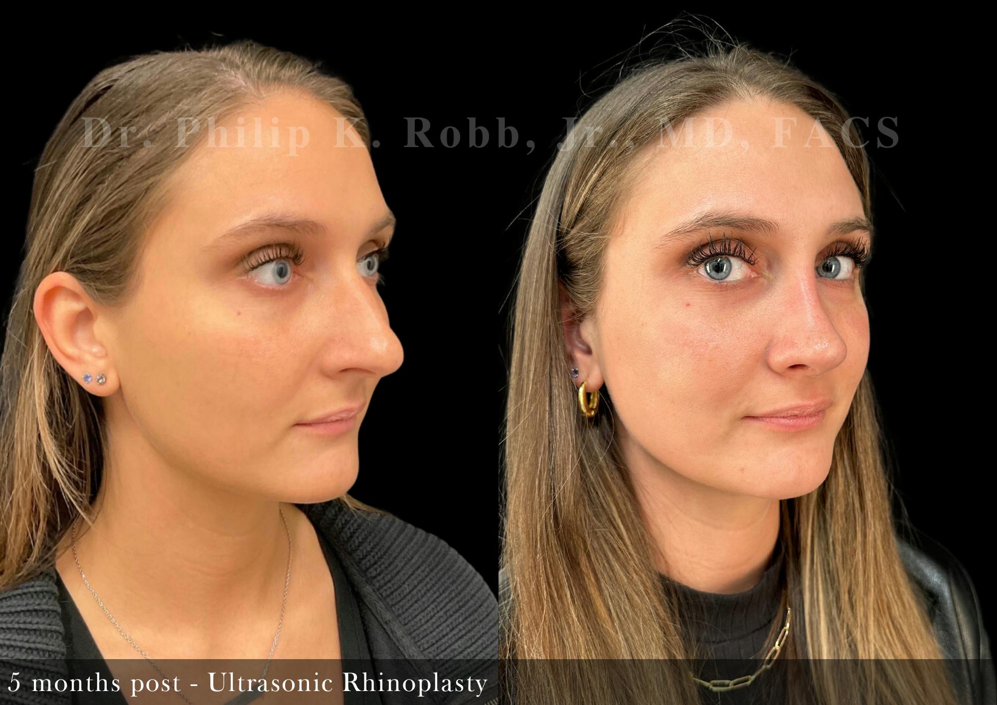 Nose Before & After Gallery - Patient 429296 - Image 4