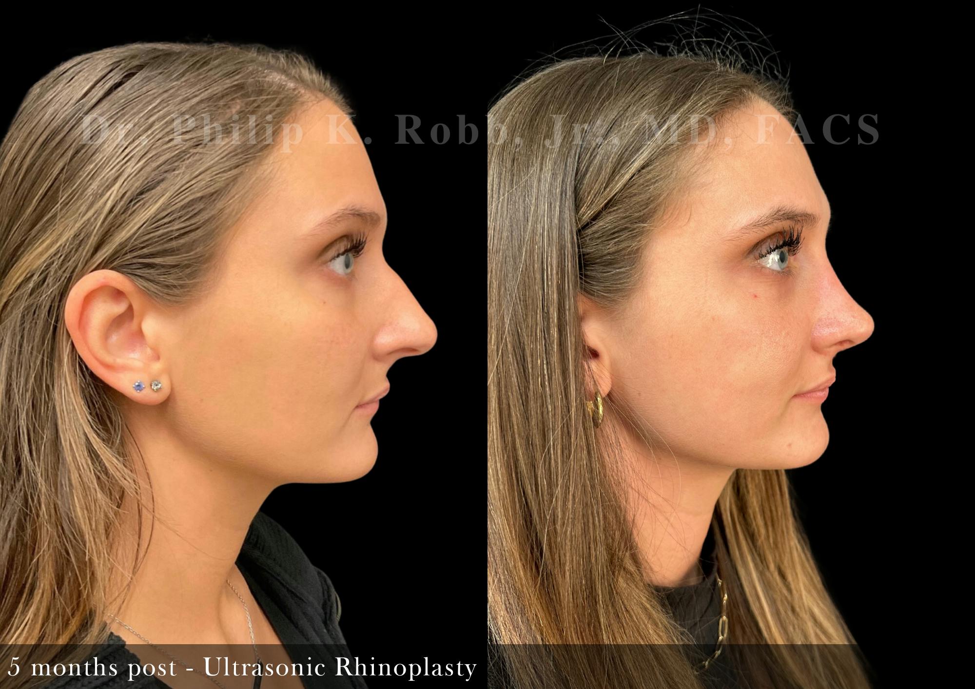 Nose Before & After Gallery - Patient 429296 - Image 5