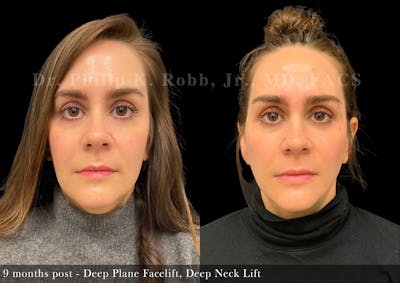 Face Before & After Gallery - Patient 418624 - Image 1