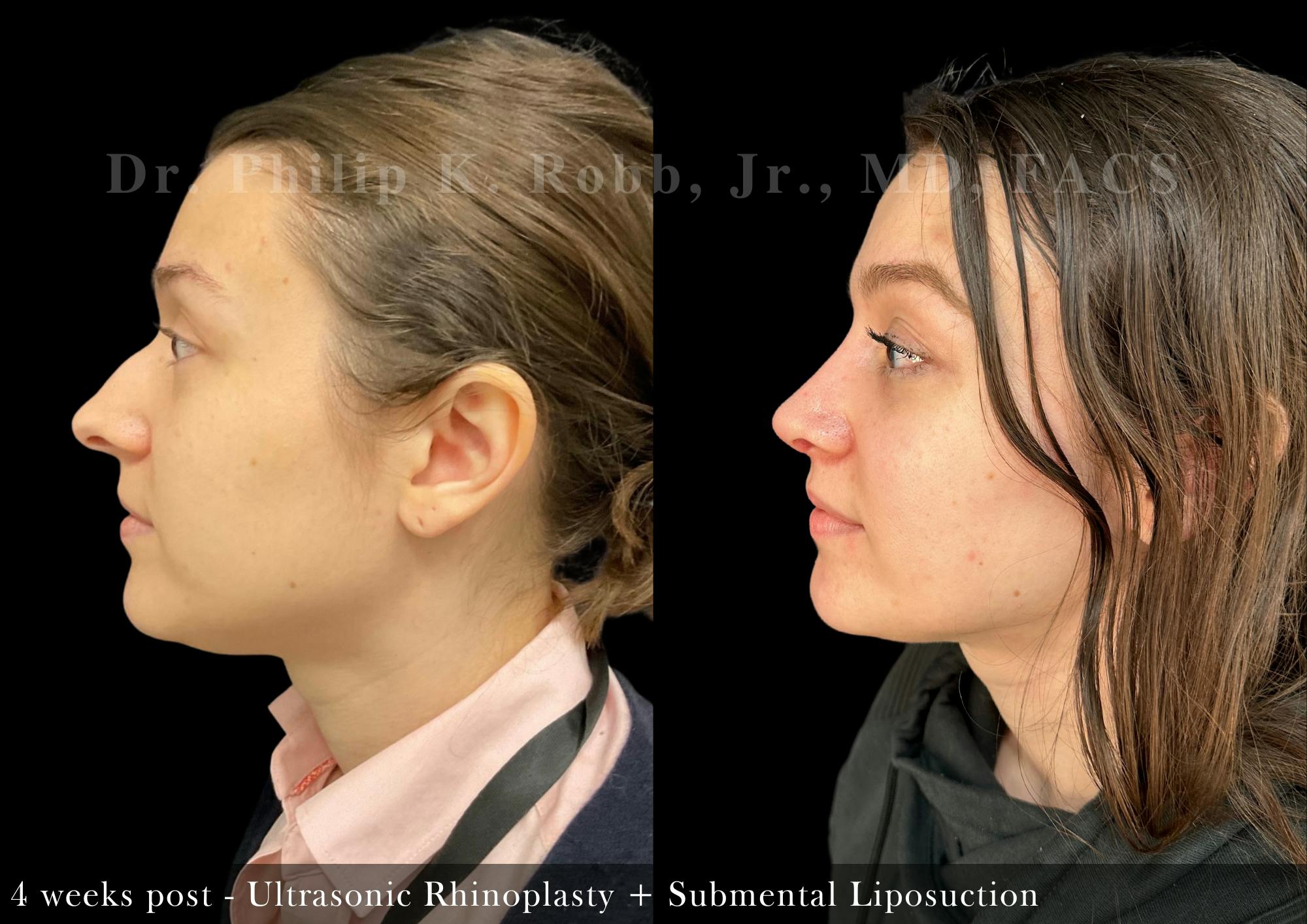 Face Before & After Gallery - Patient 391259 - Image 5