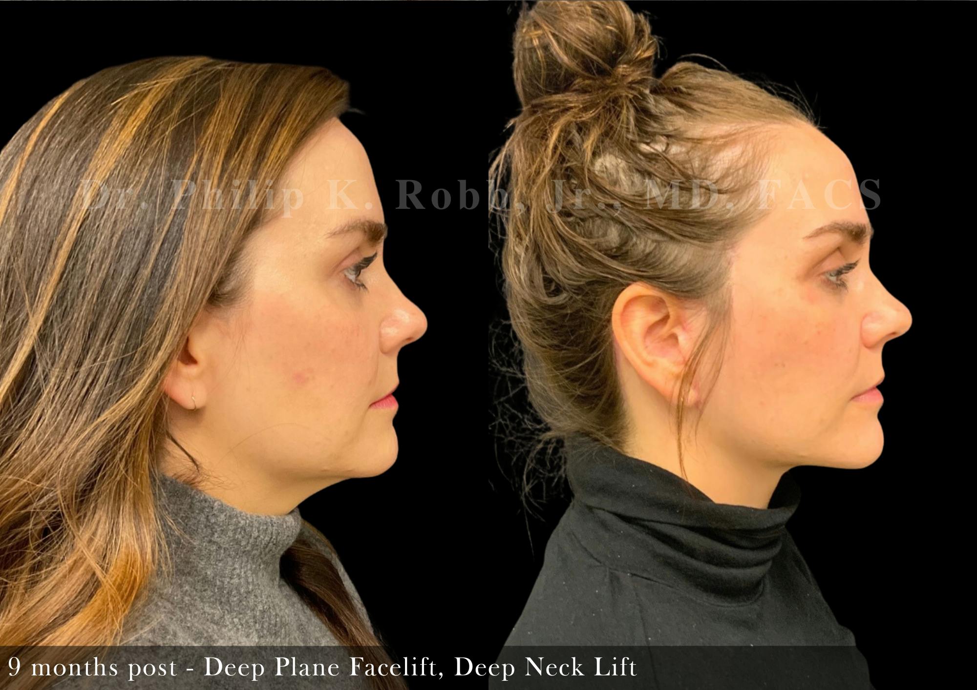 Face Before & After Gallery - Patient 418624 - Image 4