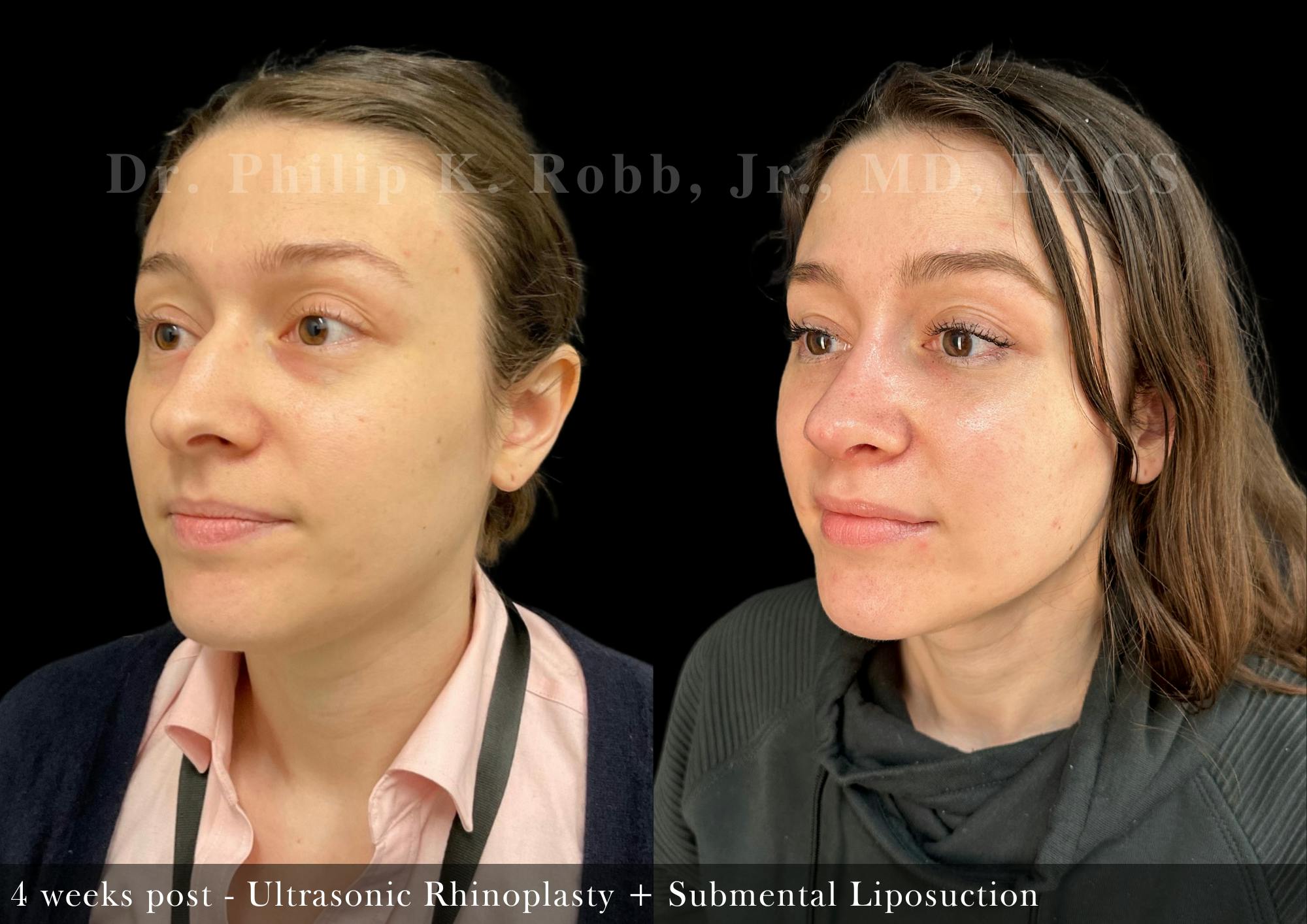 Nose Before & After Gallery - Patient 264802 - Image 4