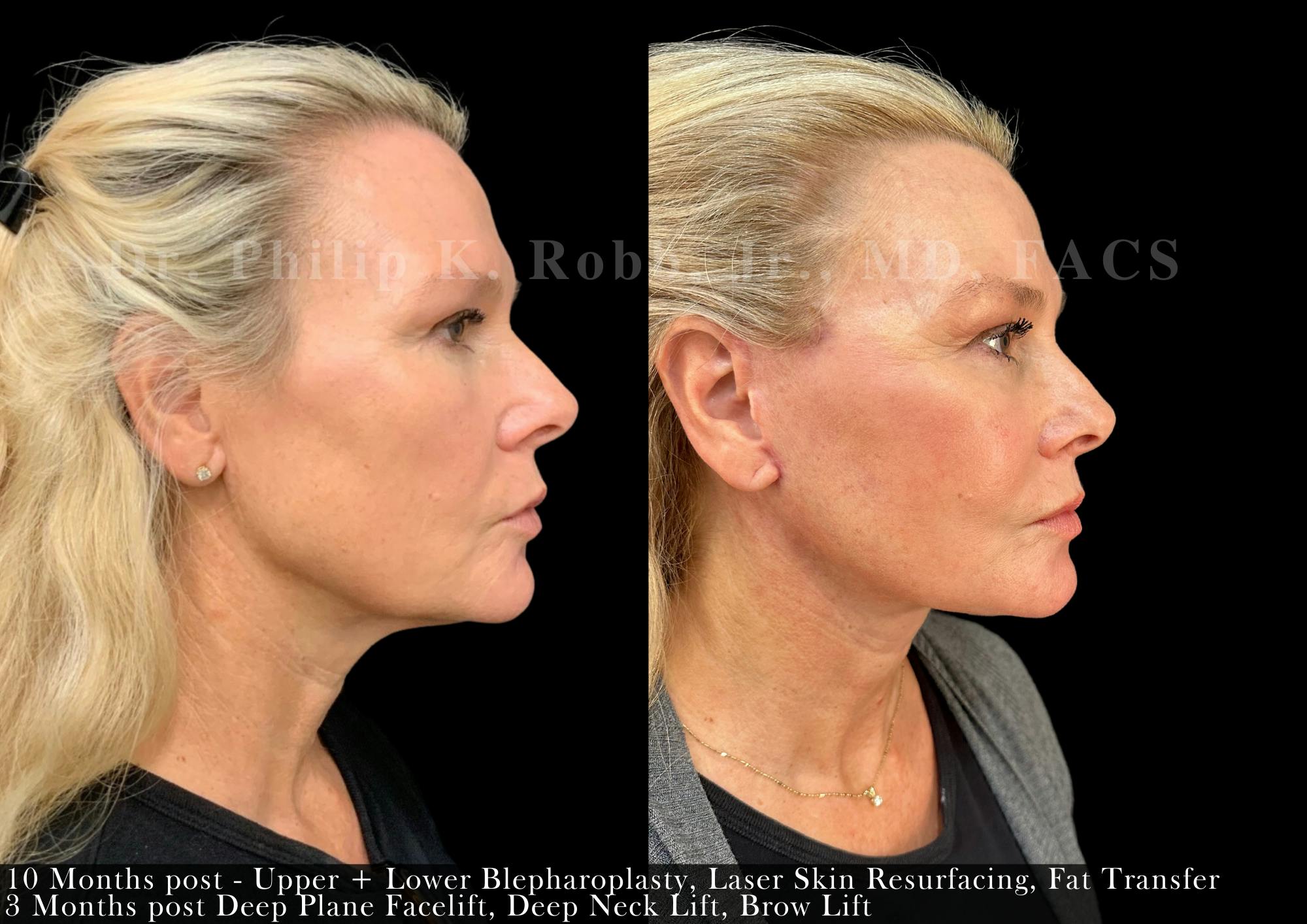 Face Before & After Gallery - Patient 982994 - Image 3