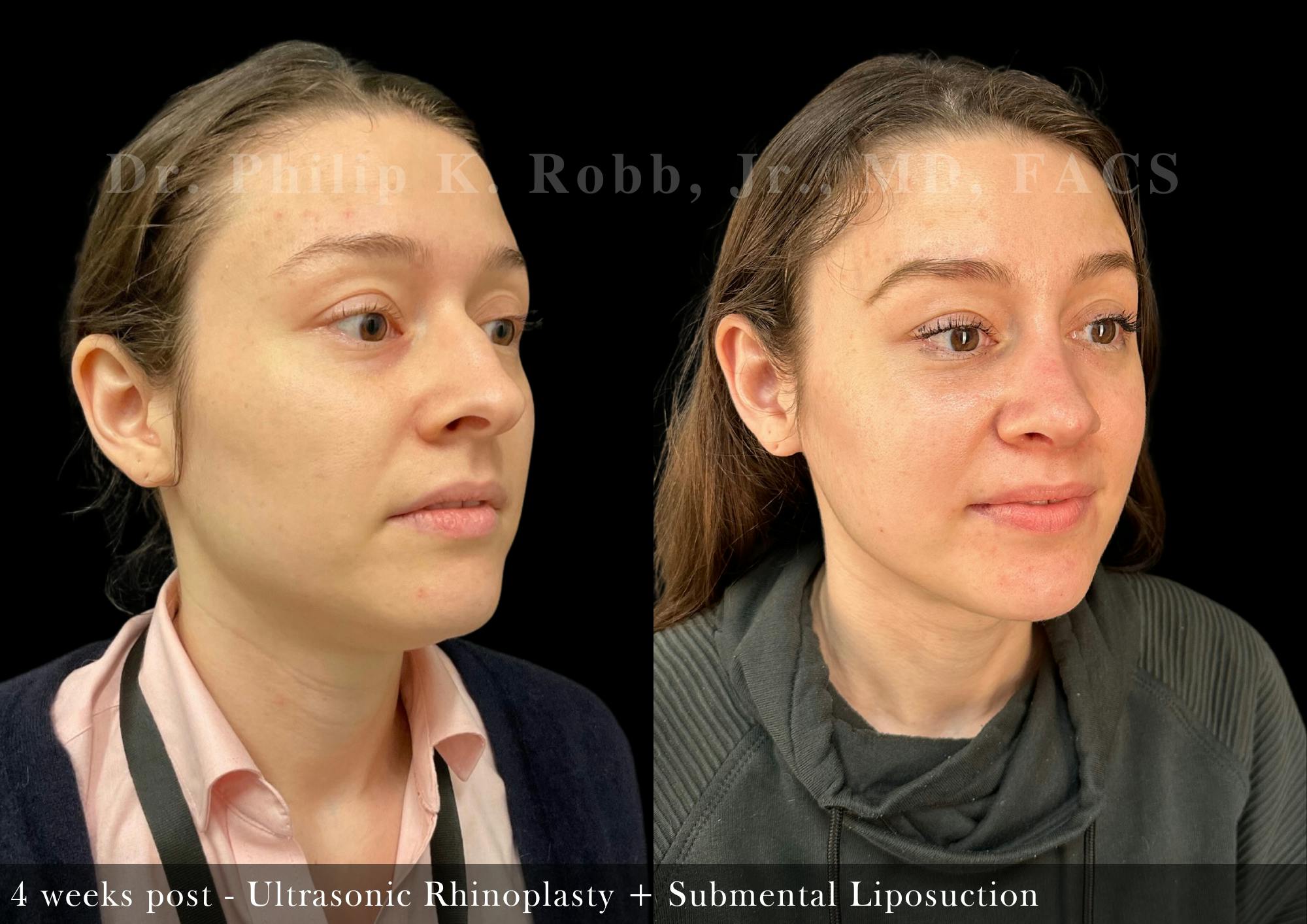 Nose Before & After Gallery - Patient 264802 - Image 2