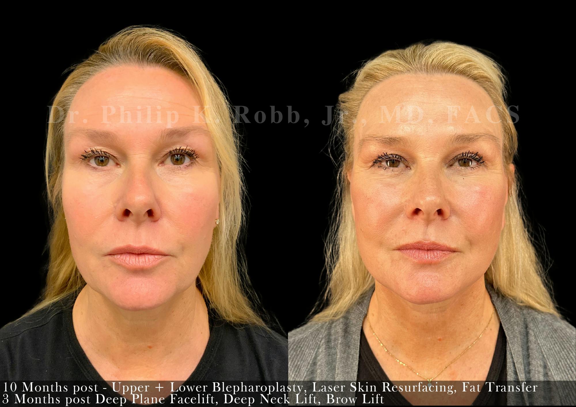 Face Before & After Gallery - Patient 982994 - Image 1