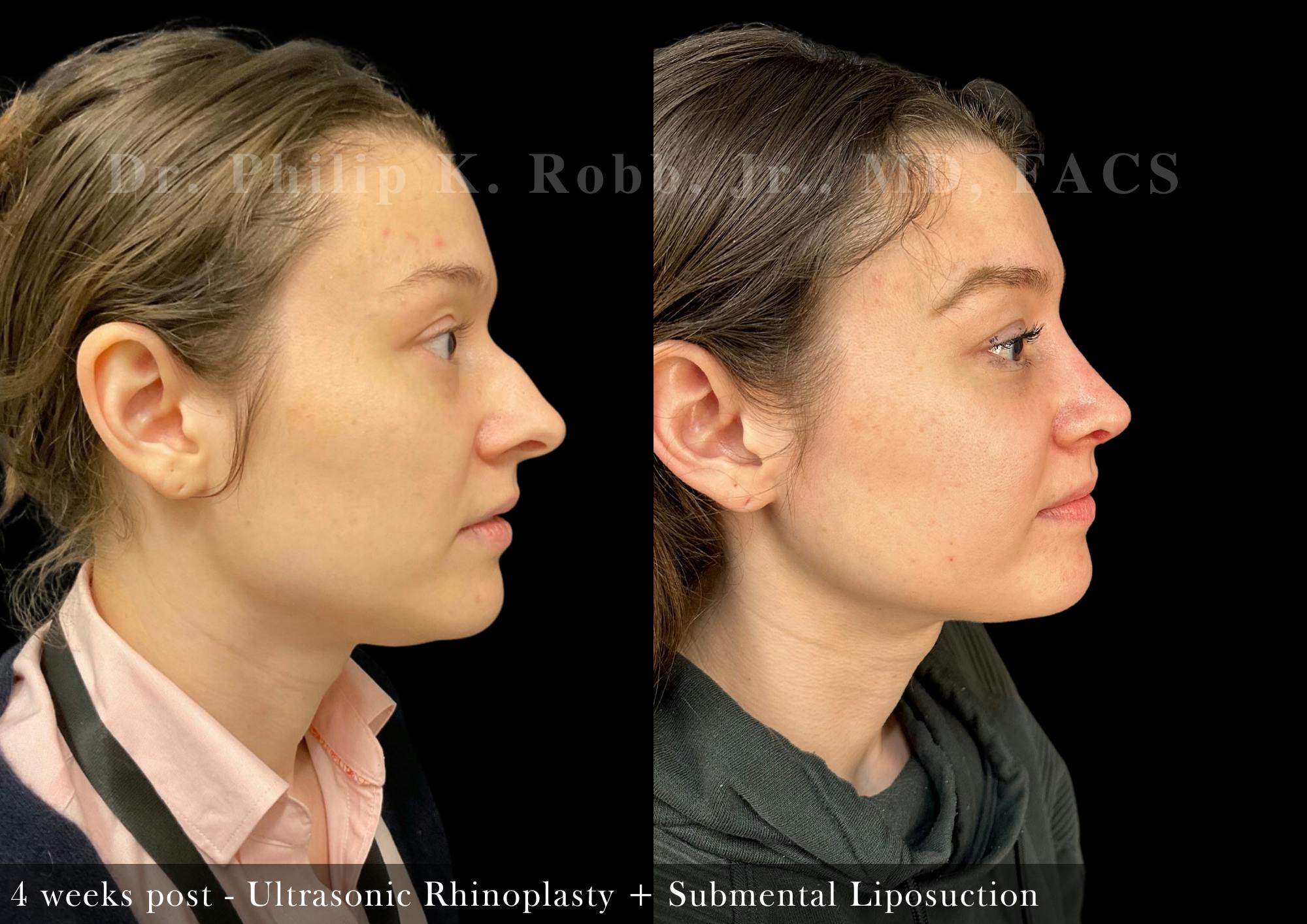 Face Before & After Gallery - Patient 391259 - Image 3