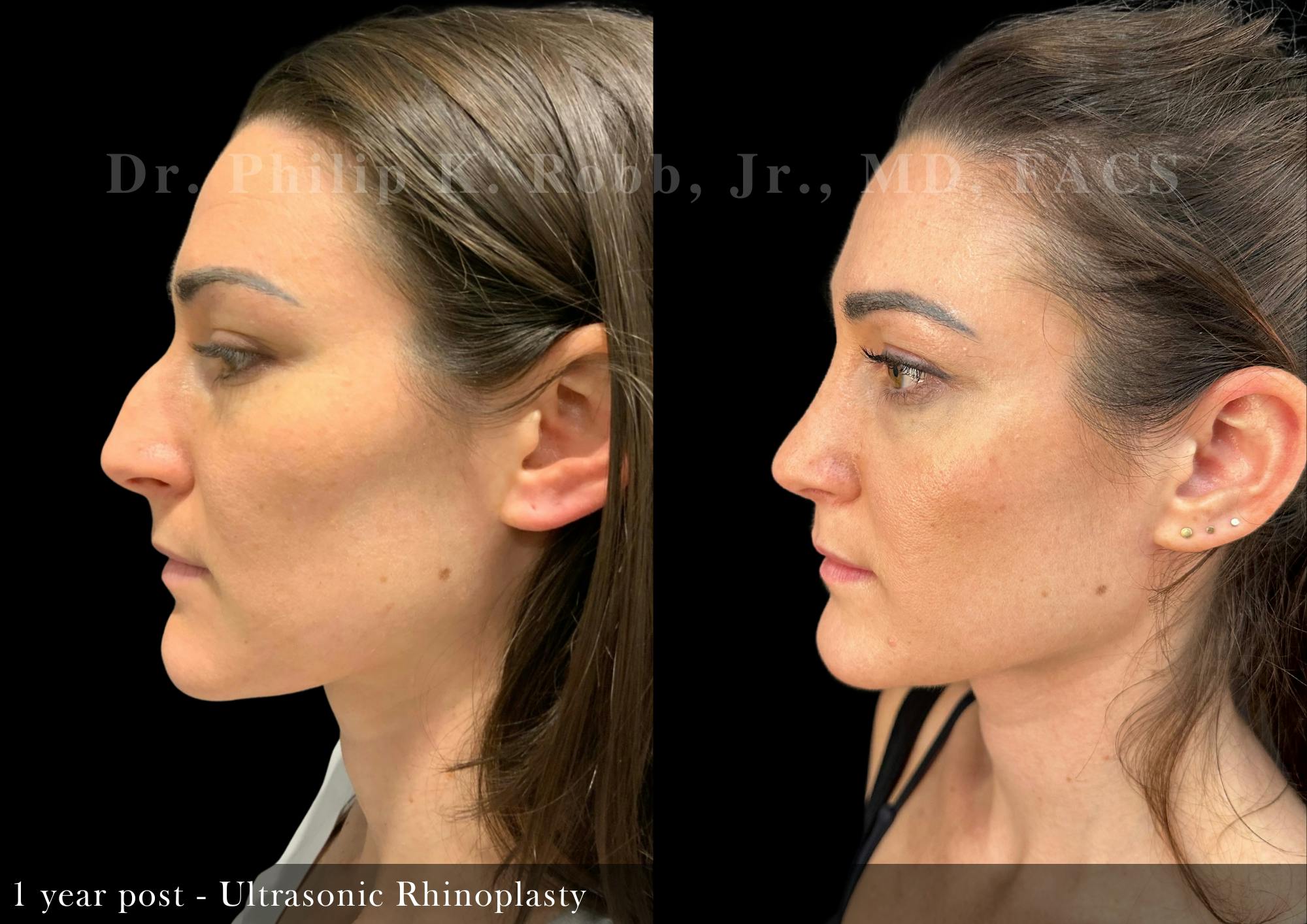 Nose Before & After Gallery - Patient 251181 - Image 1