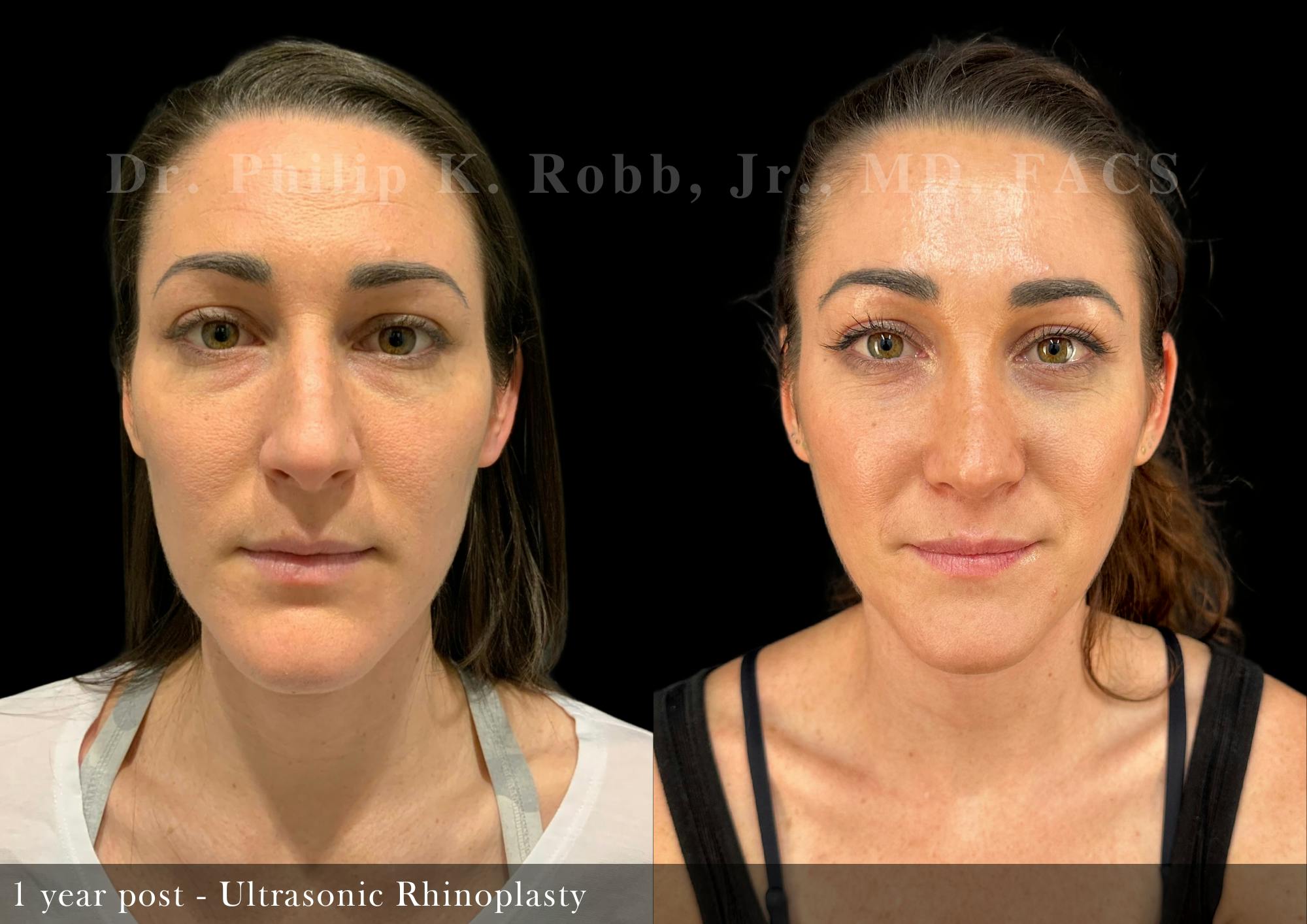 Nose Before & After Gallery - Patient 251181 - Image 5