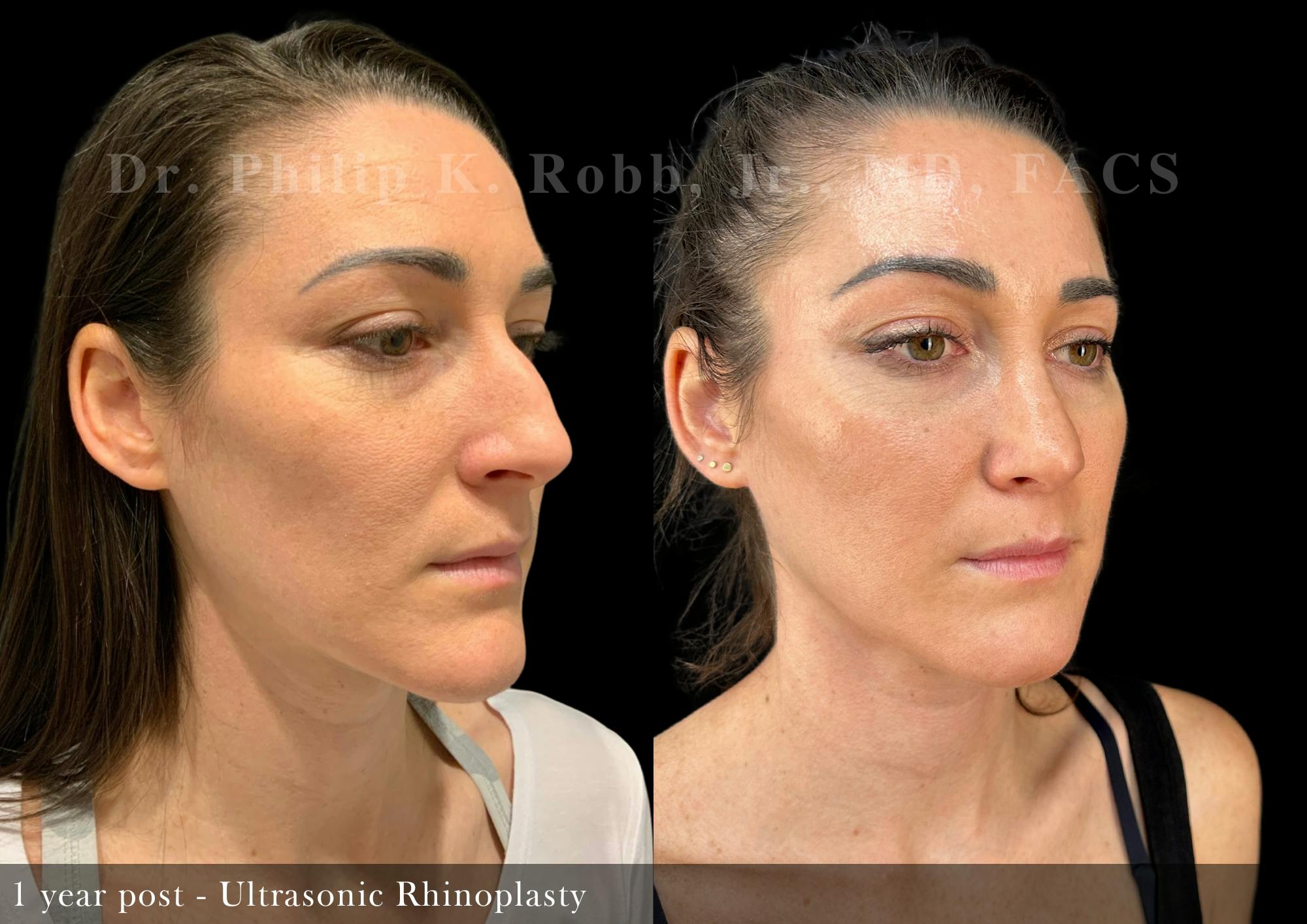 Nose Before & After Gallery - Patient 251181 - Image 4