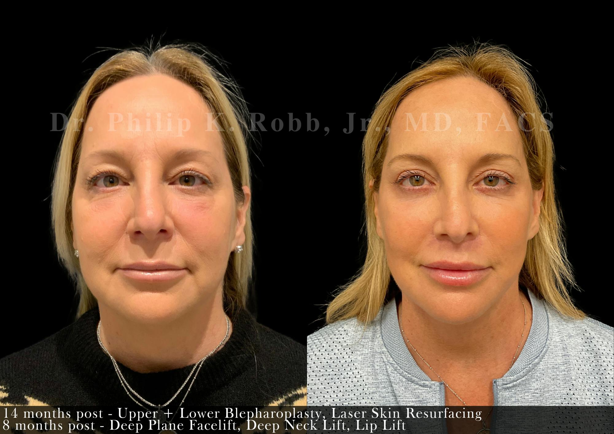 Face Before & After Gallery - Patient 351013 - Image 1