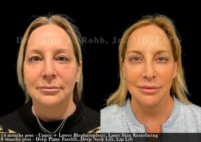 Face Before & After Gallery - Patient 351013 - Image 1