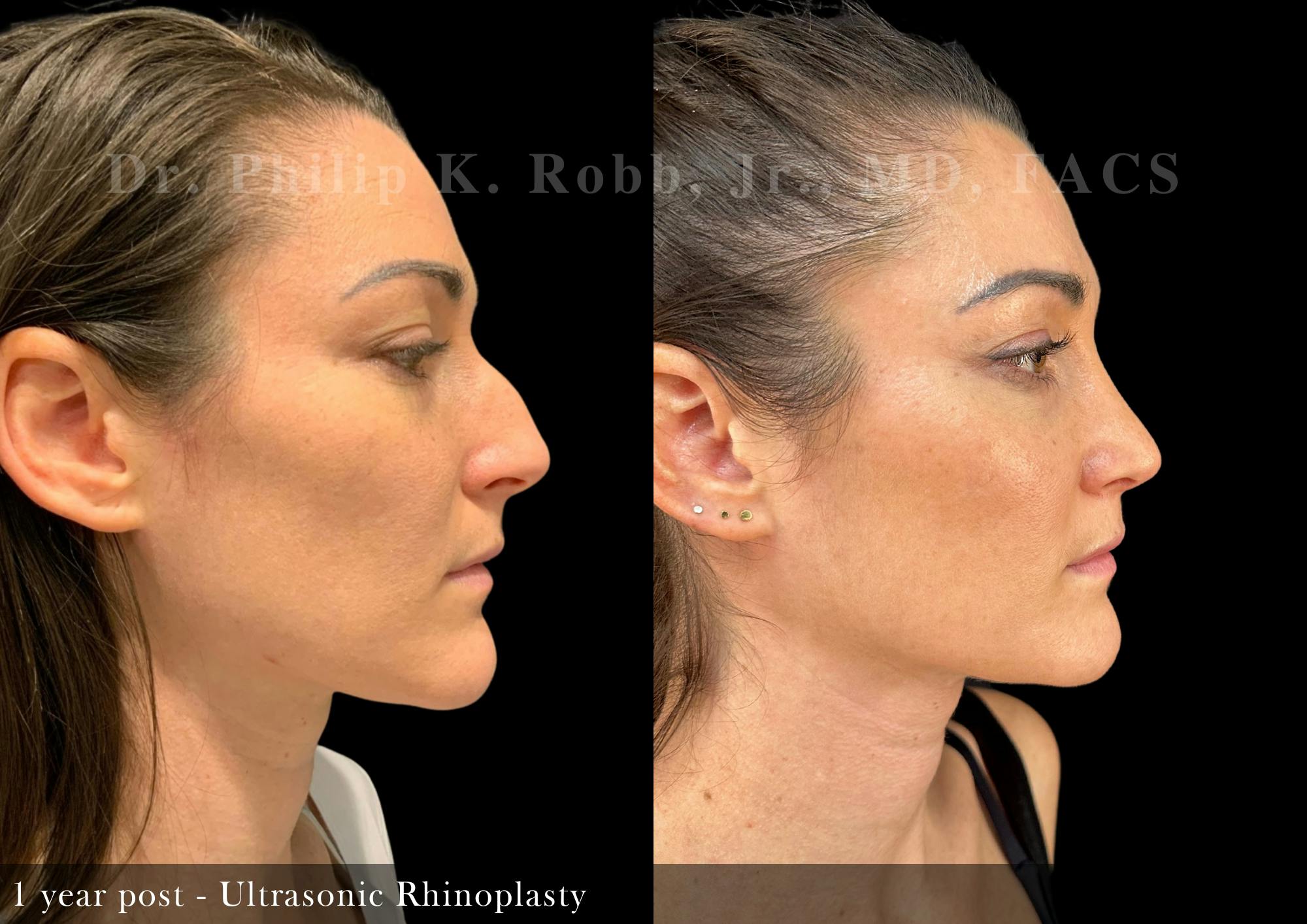 Nose Before & After Gallery - Patient 251181 - Image 2
