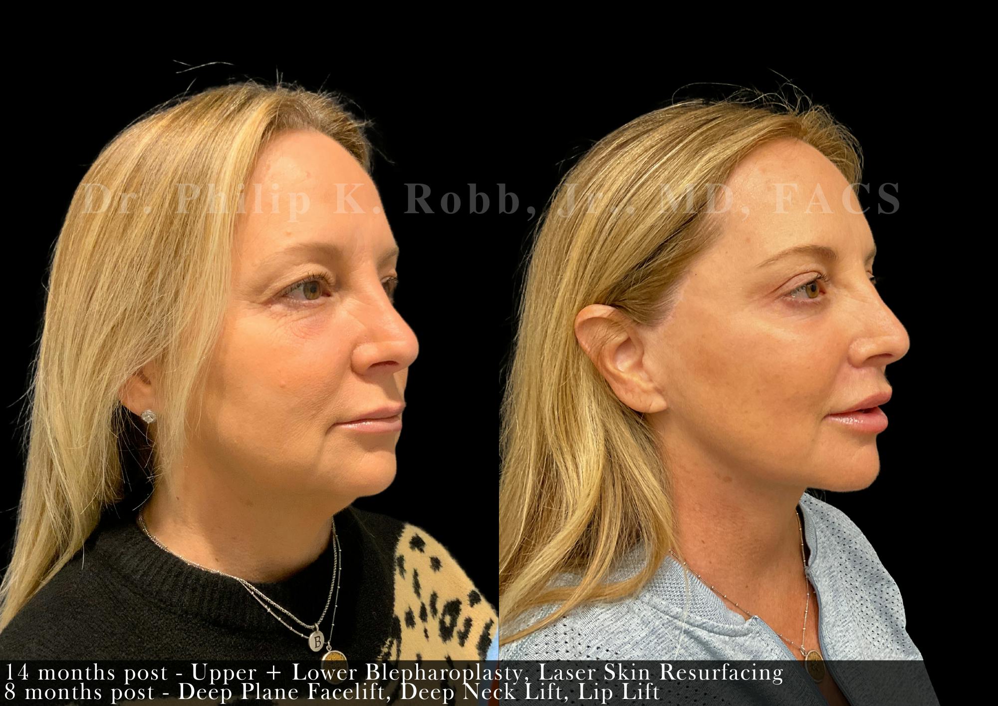 Face Before & After Gallery - Patient 351013 - Image 2