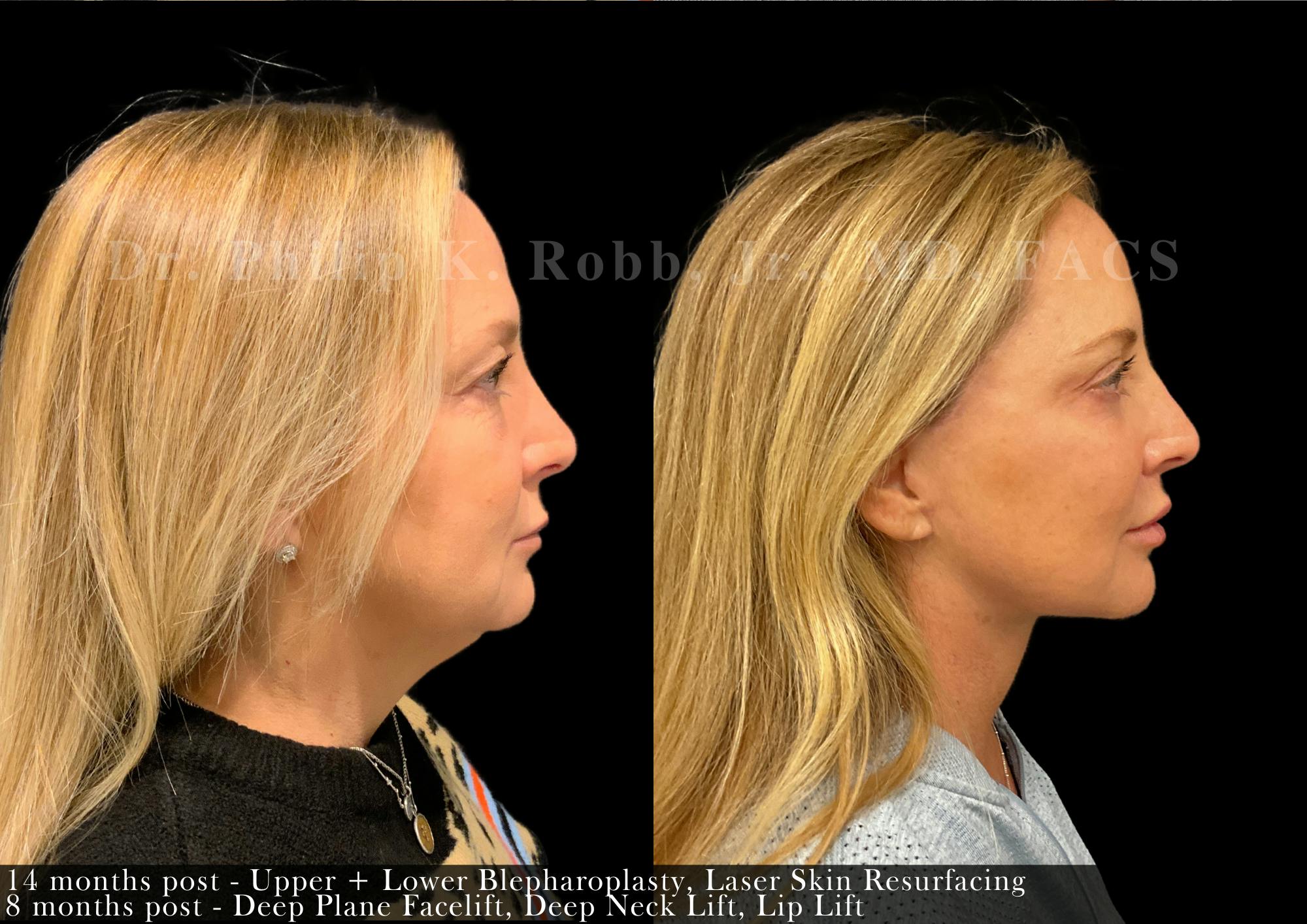 Face Before & After Gallery - Patient 351013 - Image 3