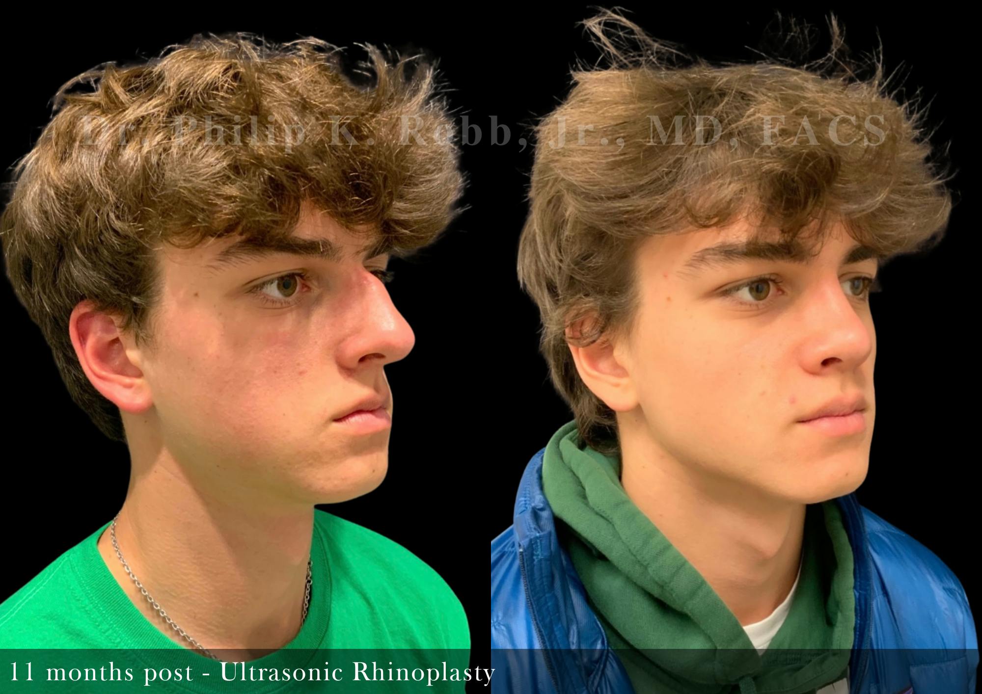 Nose Before & After Gallery - Patient 165930 - Image 5