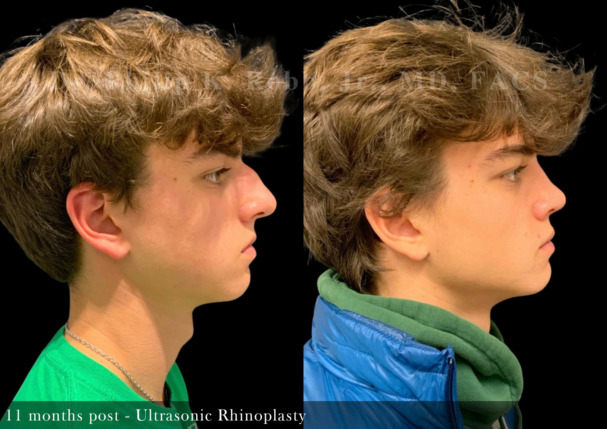 Nose Before & After Gallery - Patient 165930 - Image 1