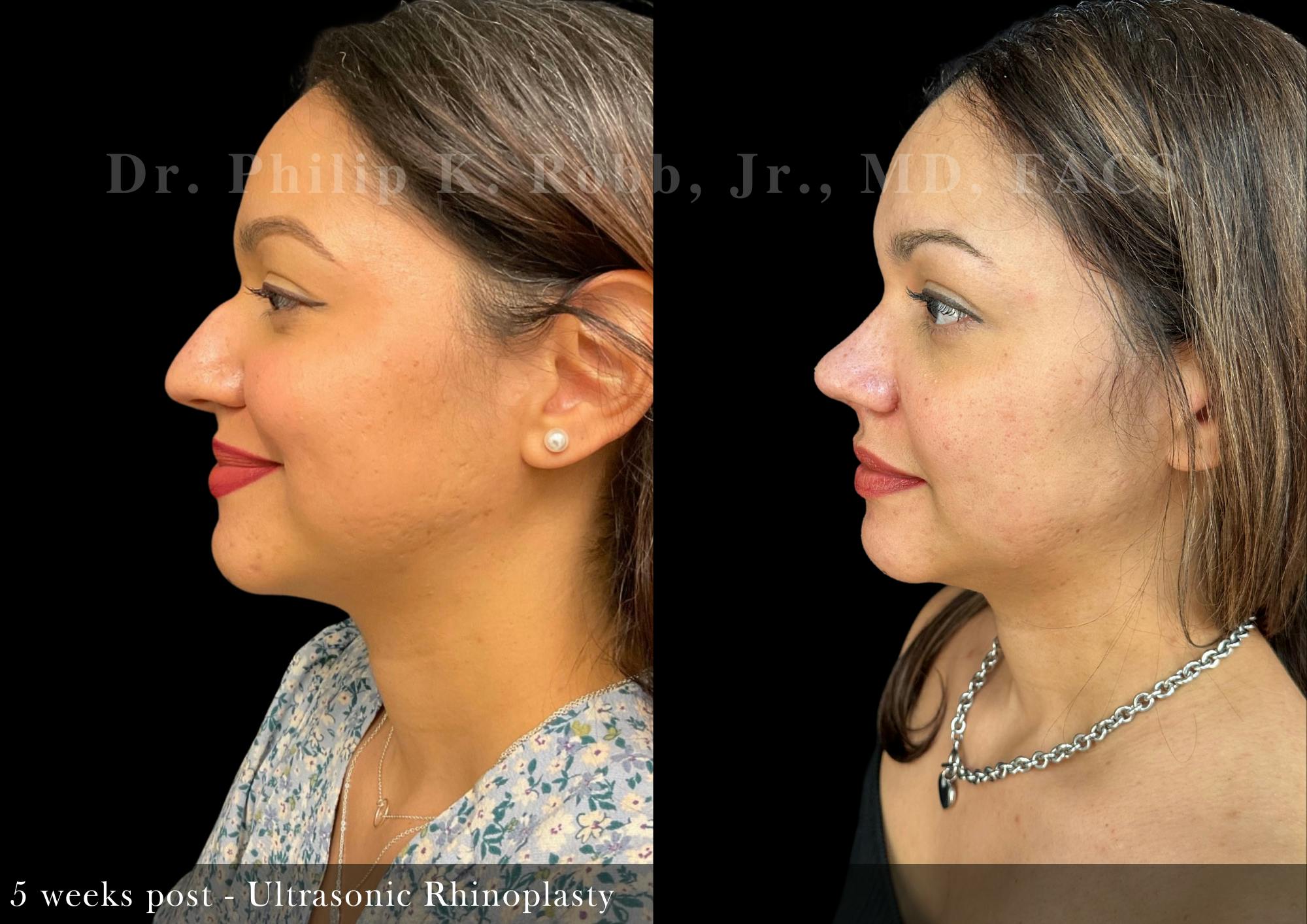 Nose Before & After Gallery - Patient 693521 - Image 2