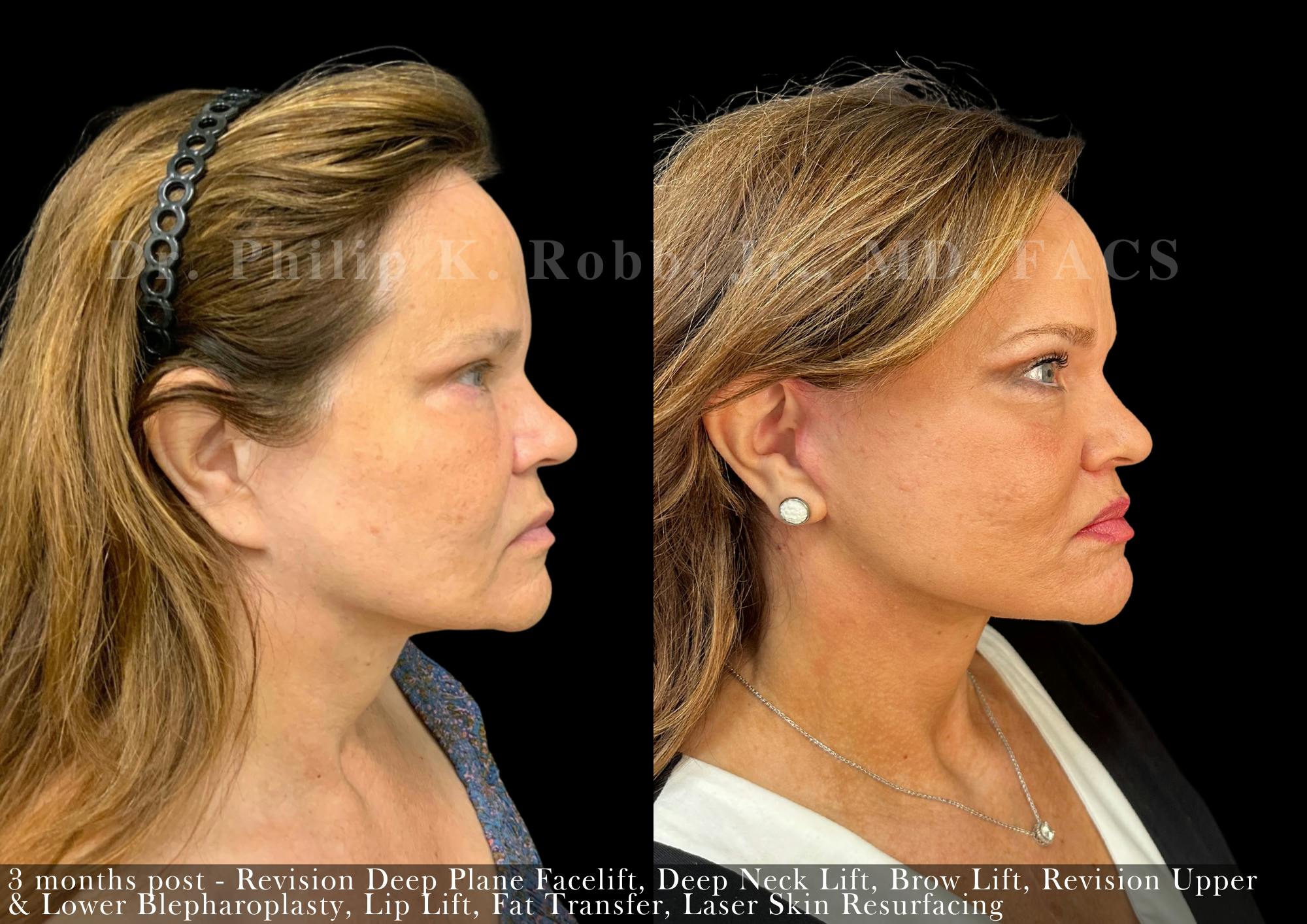Face Before & After Gallery - Patient 415656 - Image 3