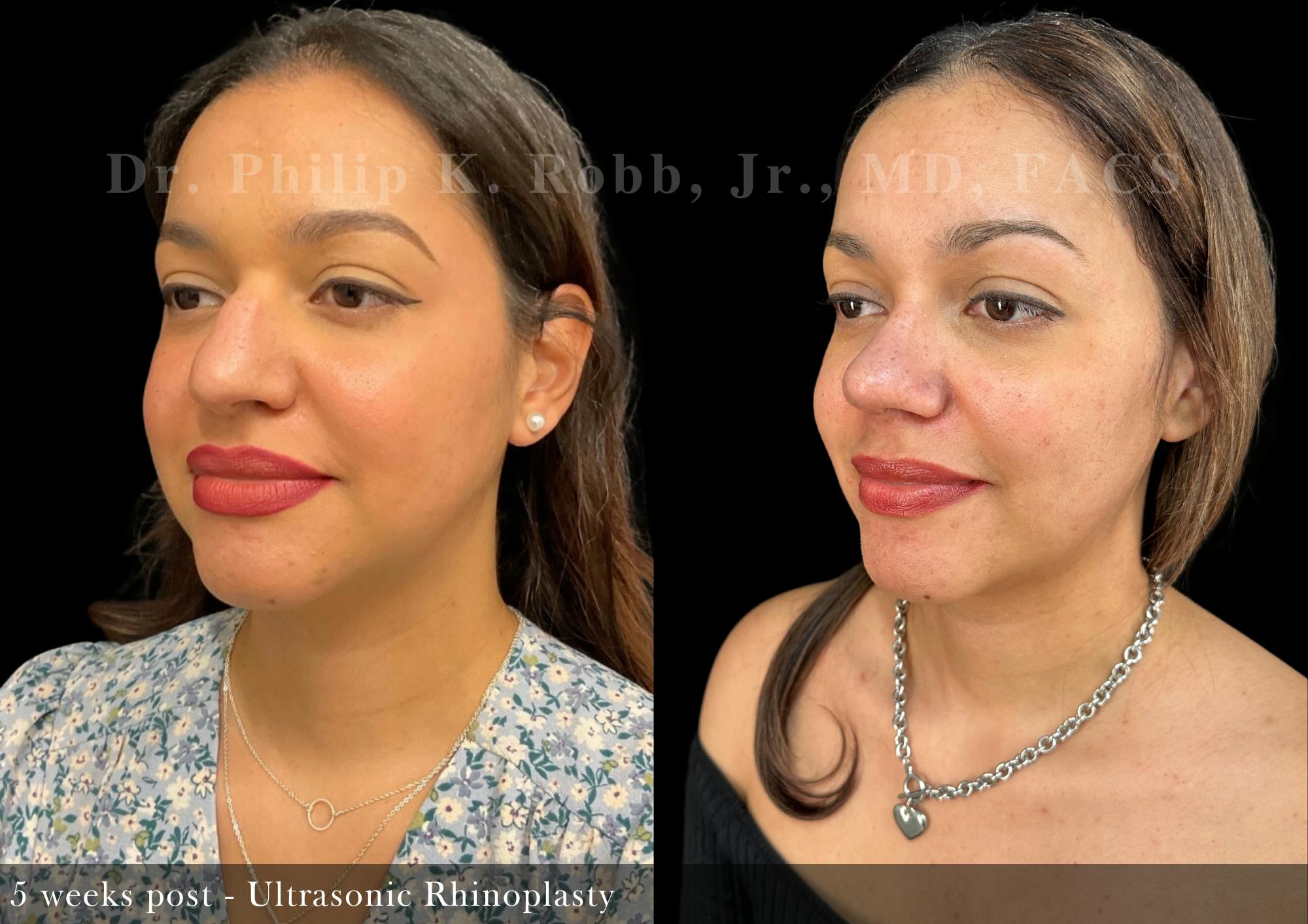 Nose Before & After Gallery - Patient 693521 - Image 3