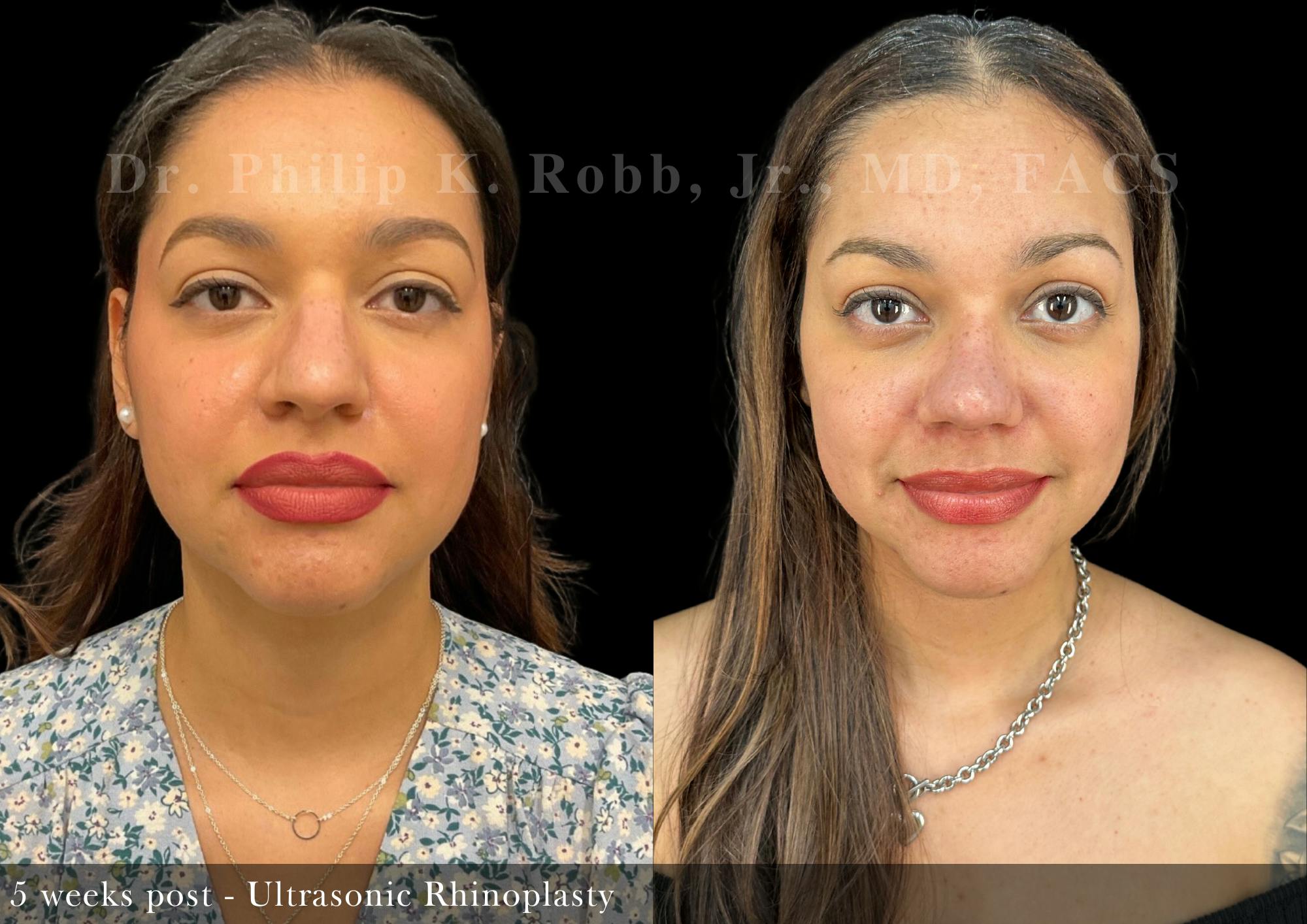 Nose Before & After Gallery - Patient 693521 - Image 4