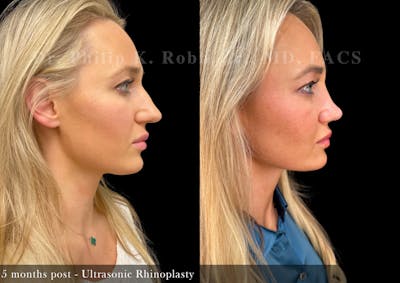 Nose Before & After Gallery - Patient 155335 - Image 1