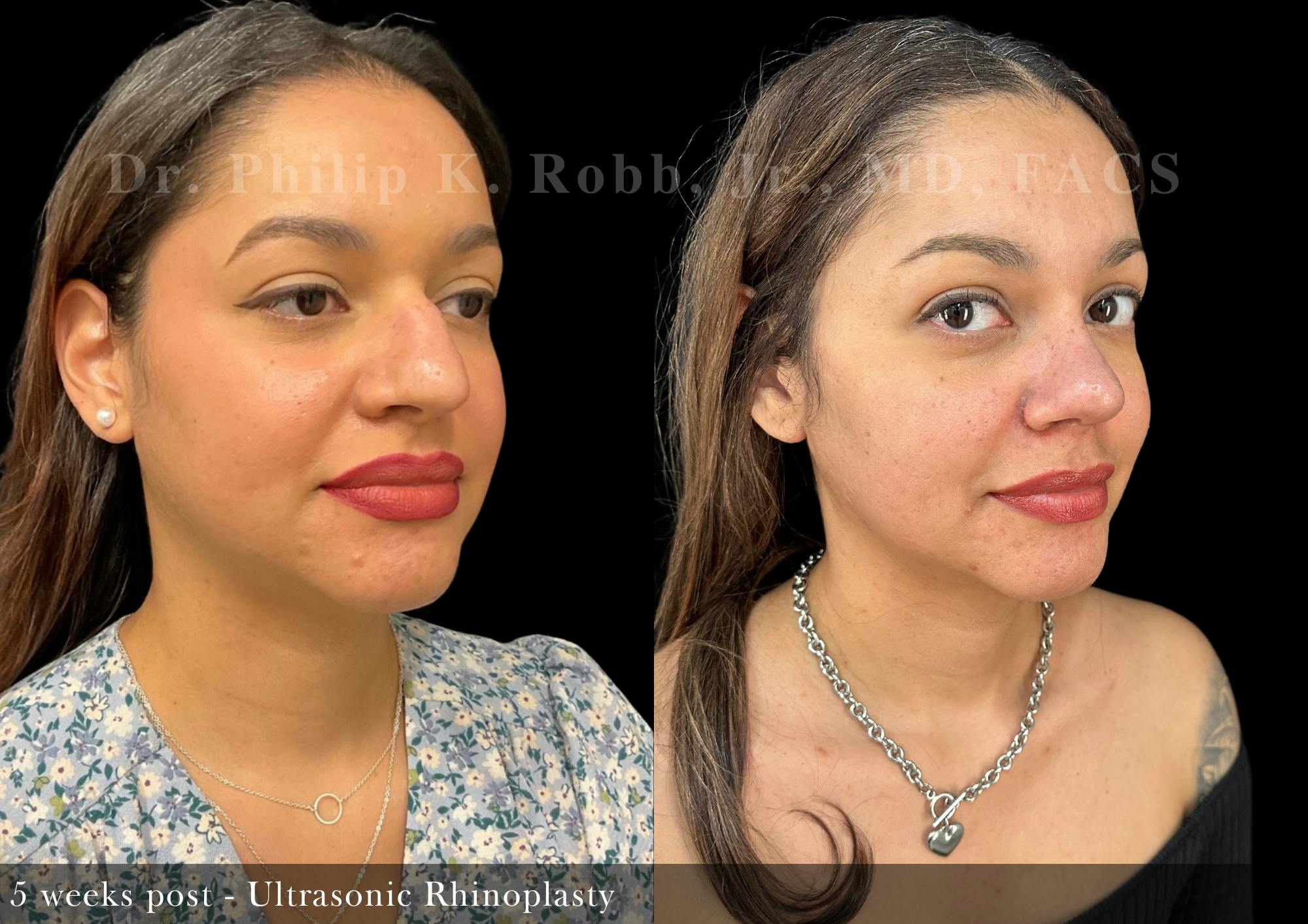 Nose Before & After Gallery - Patient 693521 - Image 5