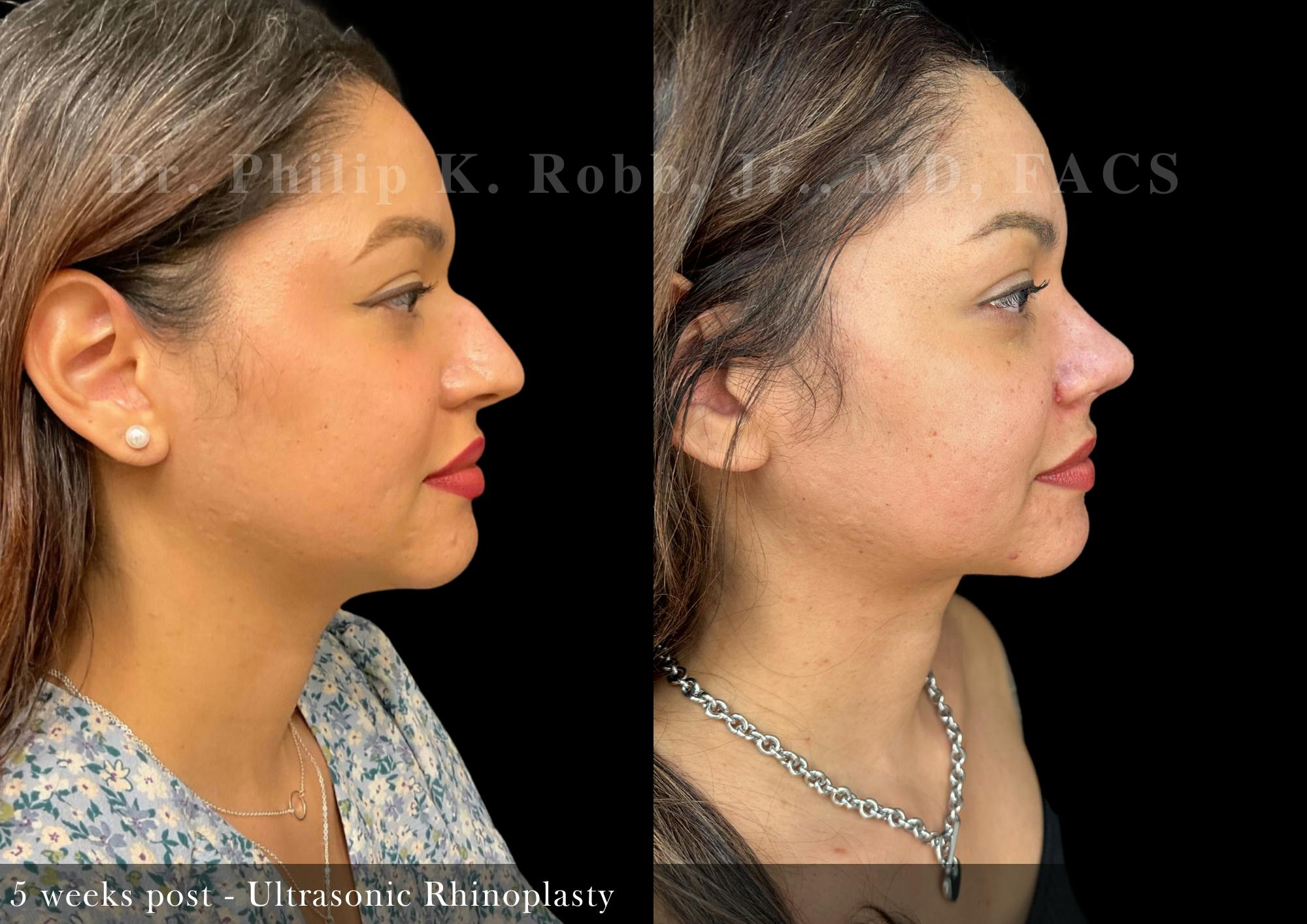 Nose Before & After Gallery - Patient 693521 - Image 1