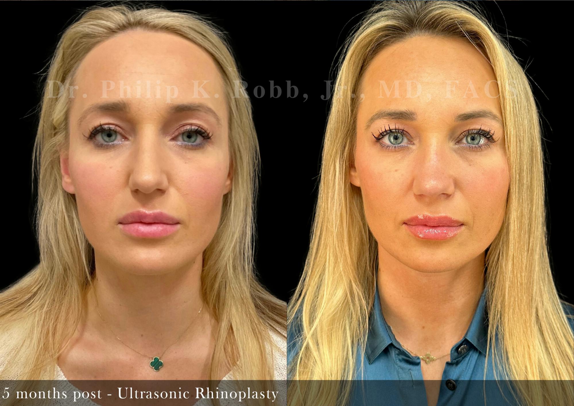 Nose Before & After Gallery - Patient 155335 - Image 4