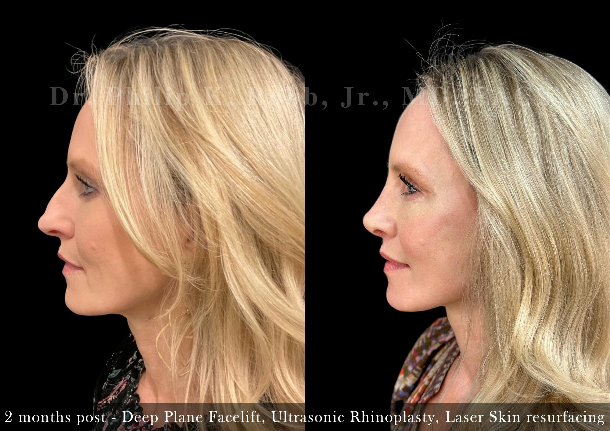 Face Before & After Gallery - Patient 298634 - Image 5