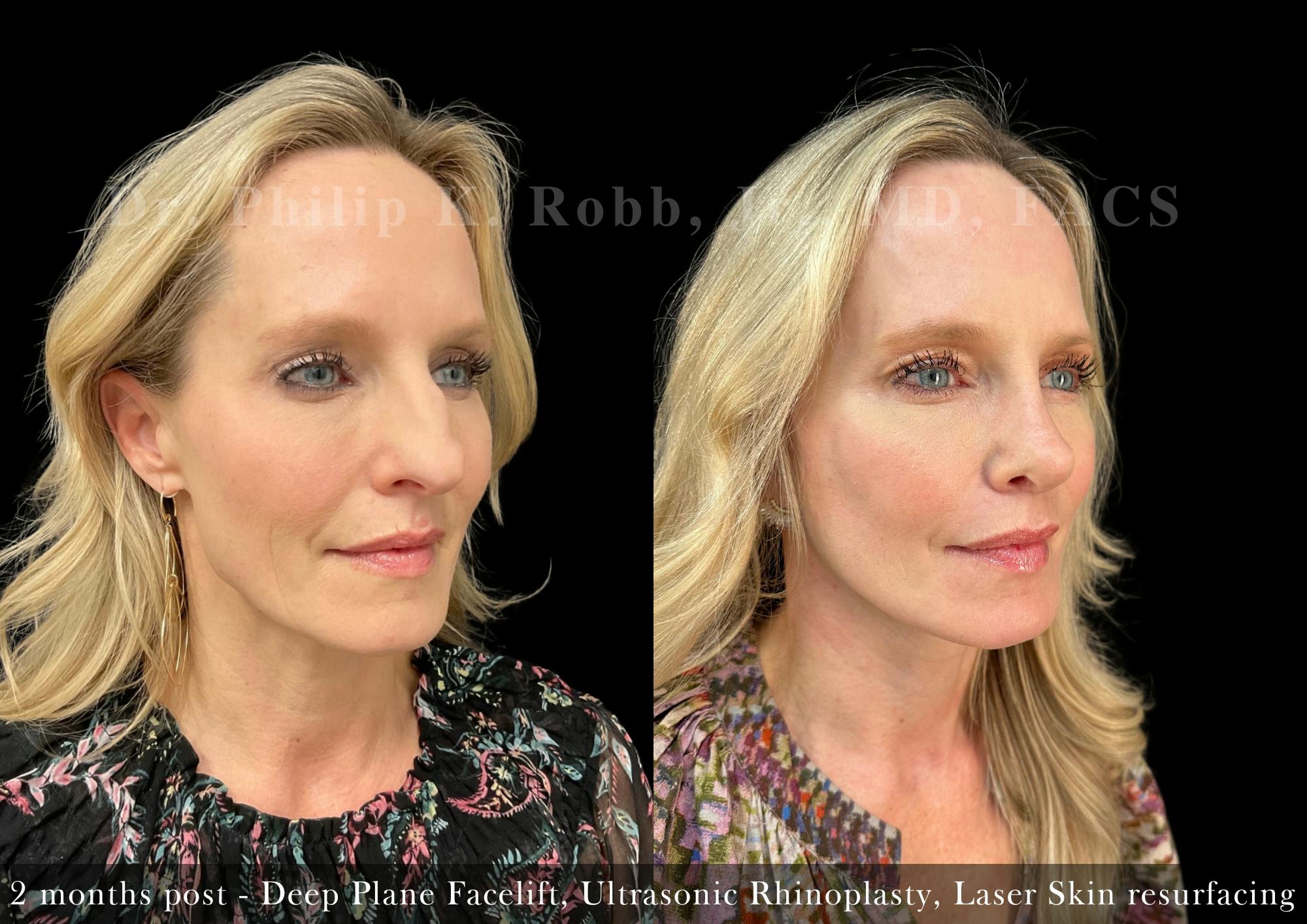 Nose Before & After Gallery - Patient 355043 - Image 5