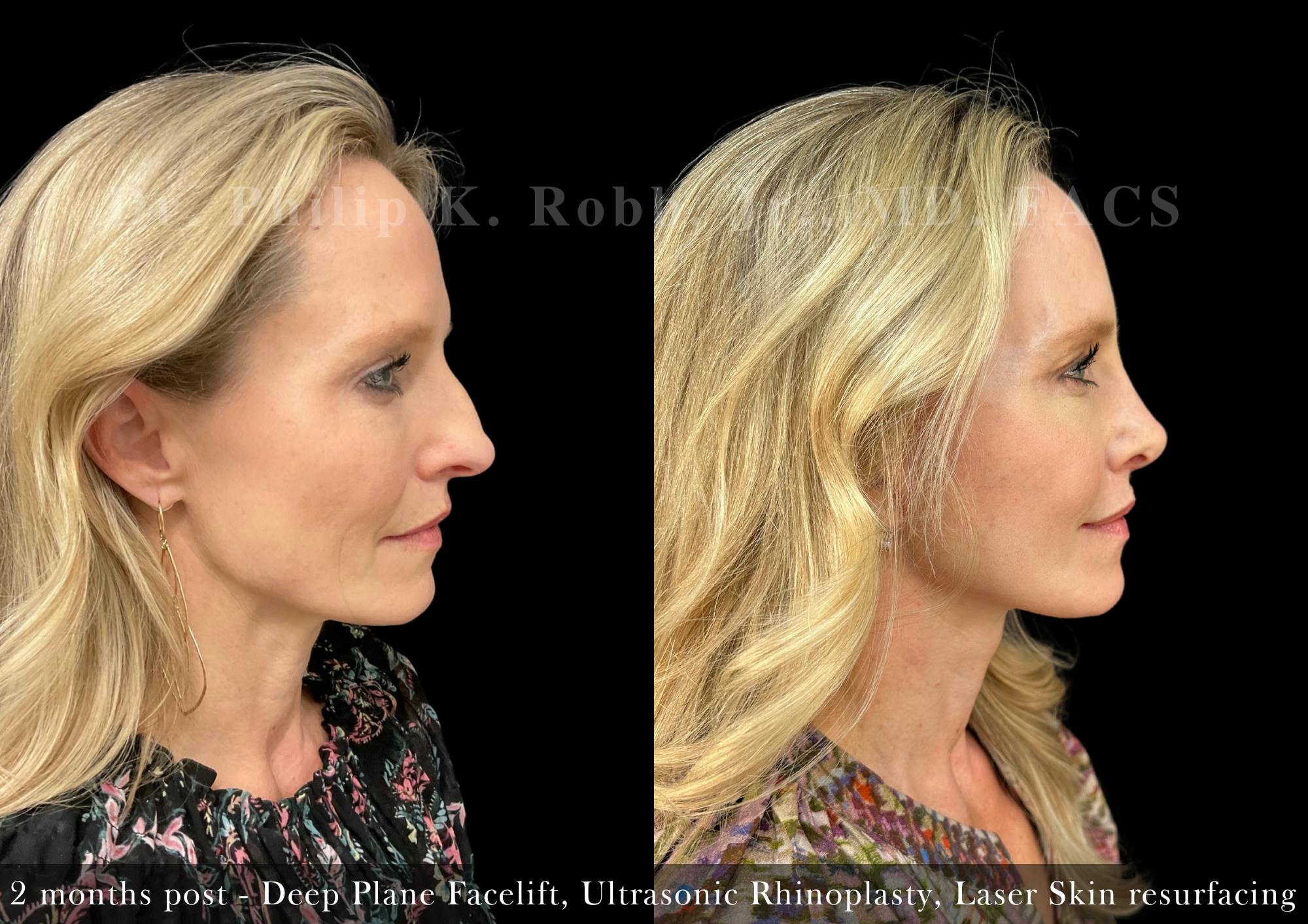 Nose Before & After Gallery - Patient 355043 - Image 1