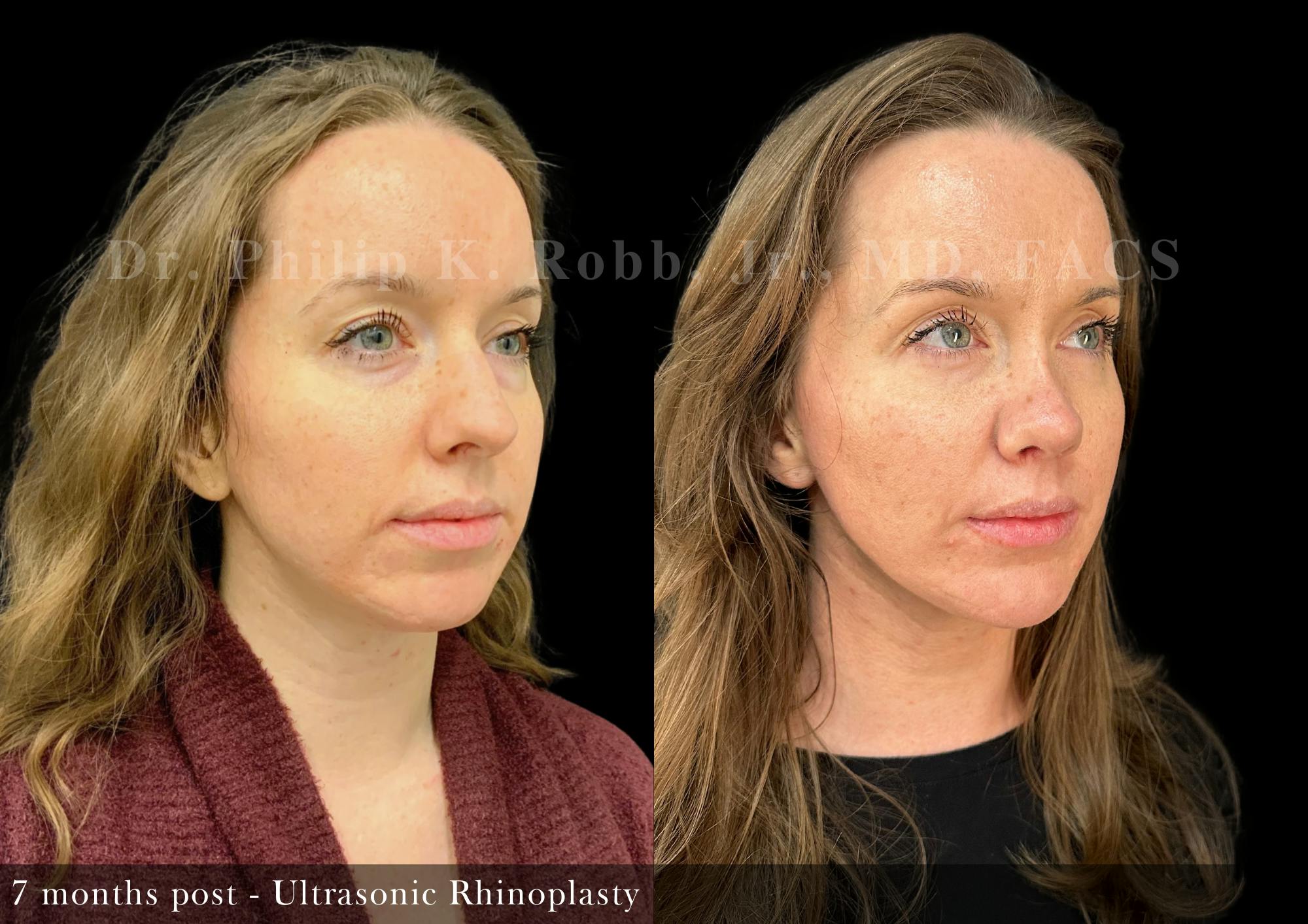 Nose Before & After Gallery - Patient 126946 - Image 5