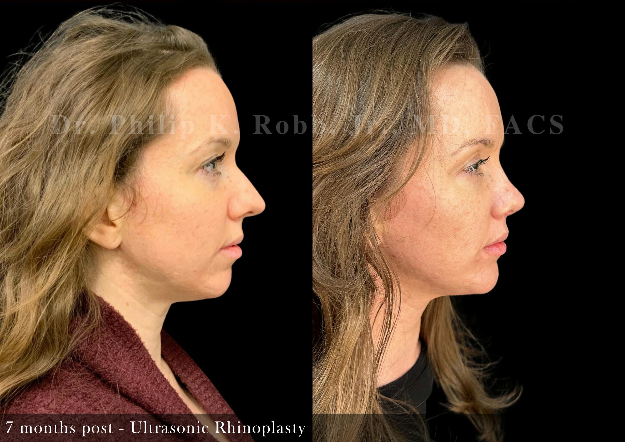 Nose Before & After Gallery - Patient 126946 - Image 1