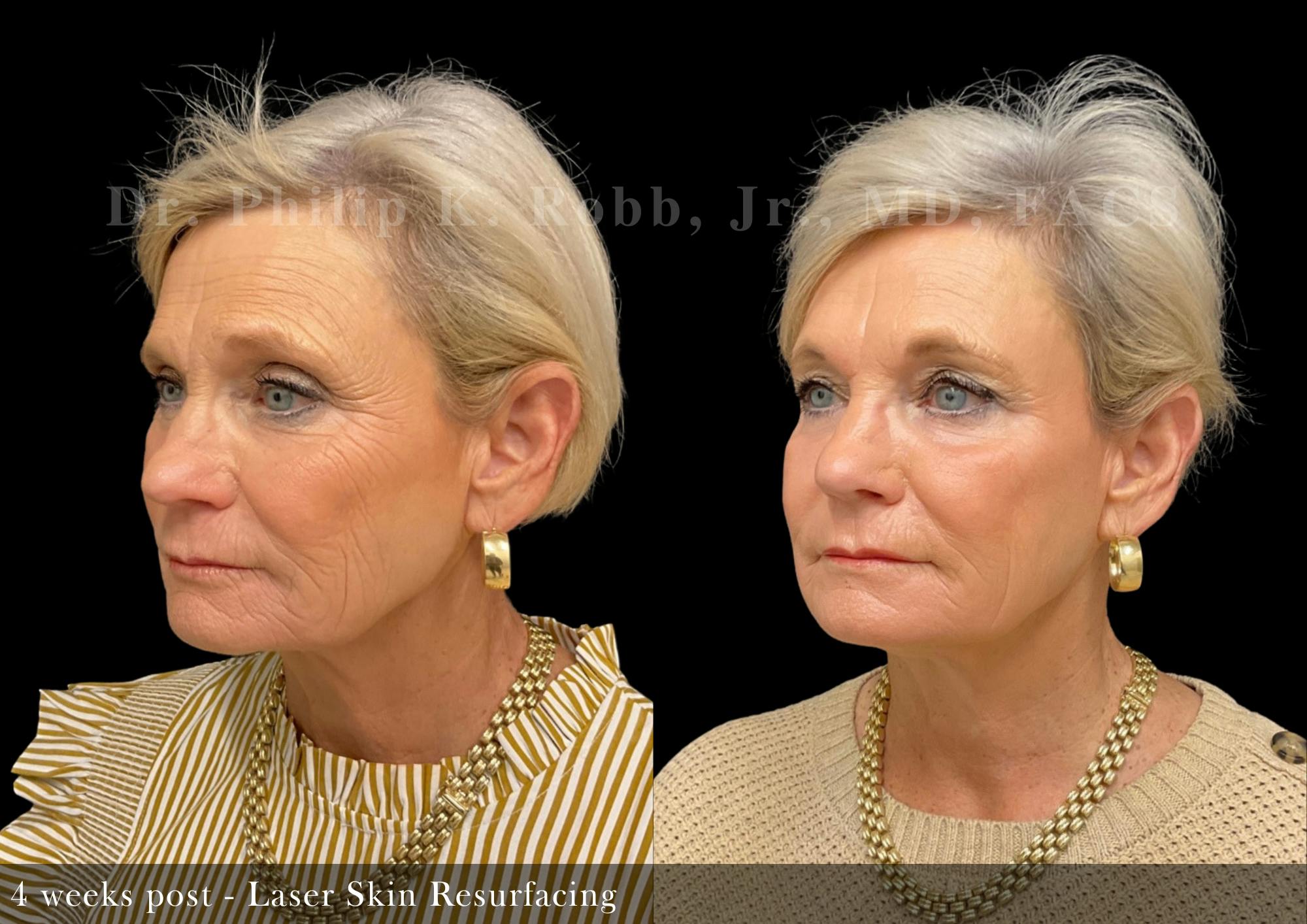 Face Before & After Gallery - Patient 252034 - Image 2