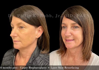 Face Before & After Gallery - Patient 415817 - Image 1