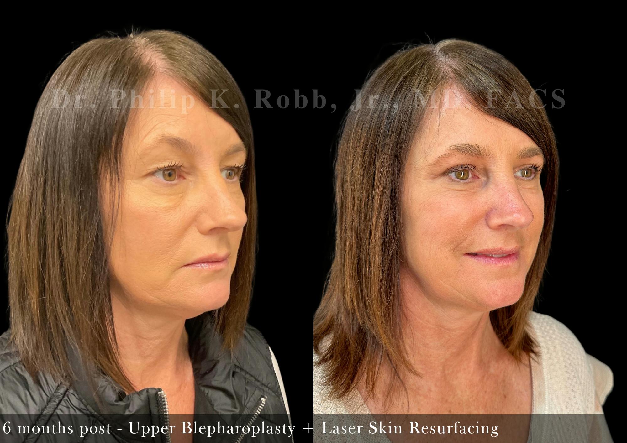 Face Before & After Gallery - Patient 415817 - Image 3