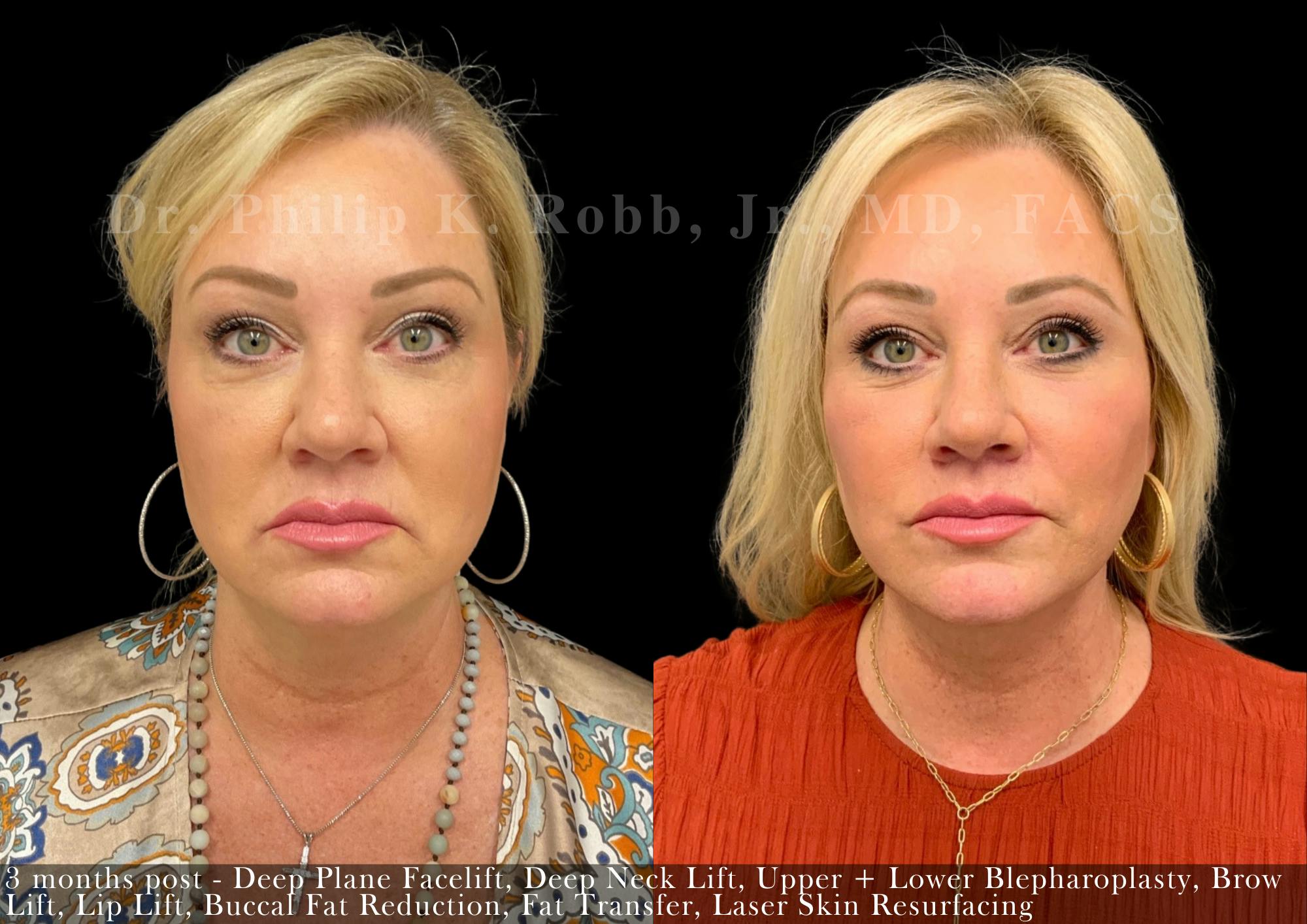 Face Before & After Gallery - Patient 268743 - Image 1