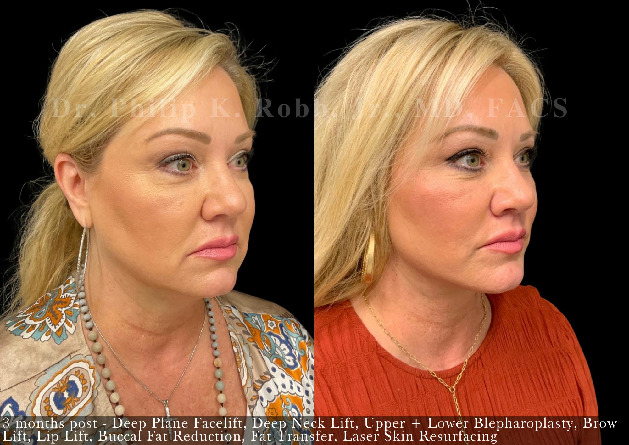 Face Before & After Gallery - Patient 268743 - Image 2