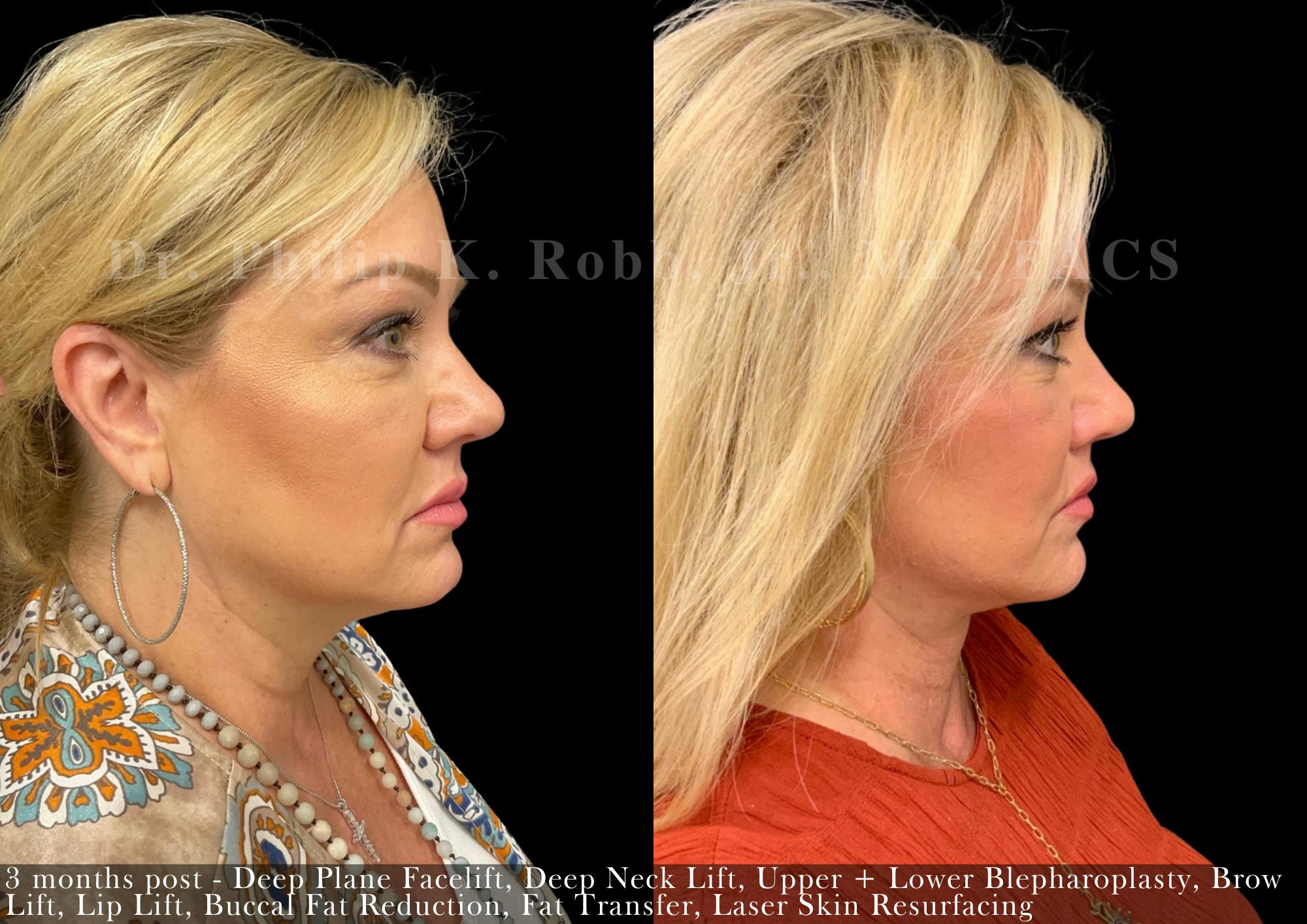 Face Before & After Gallery - Patient 268743 - Image 3