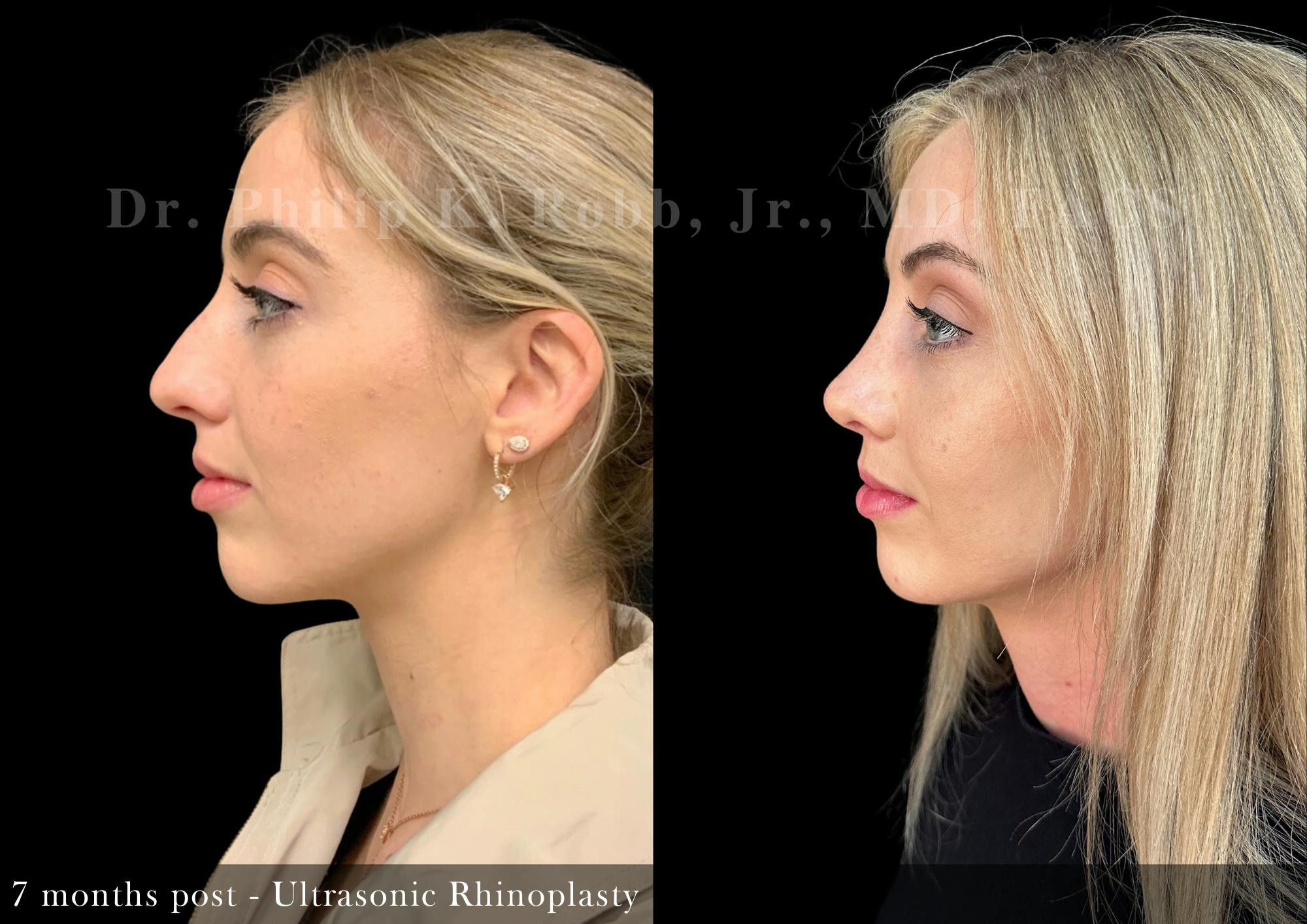 Nose Before & After Gallery - Patient 862654 - Image 3